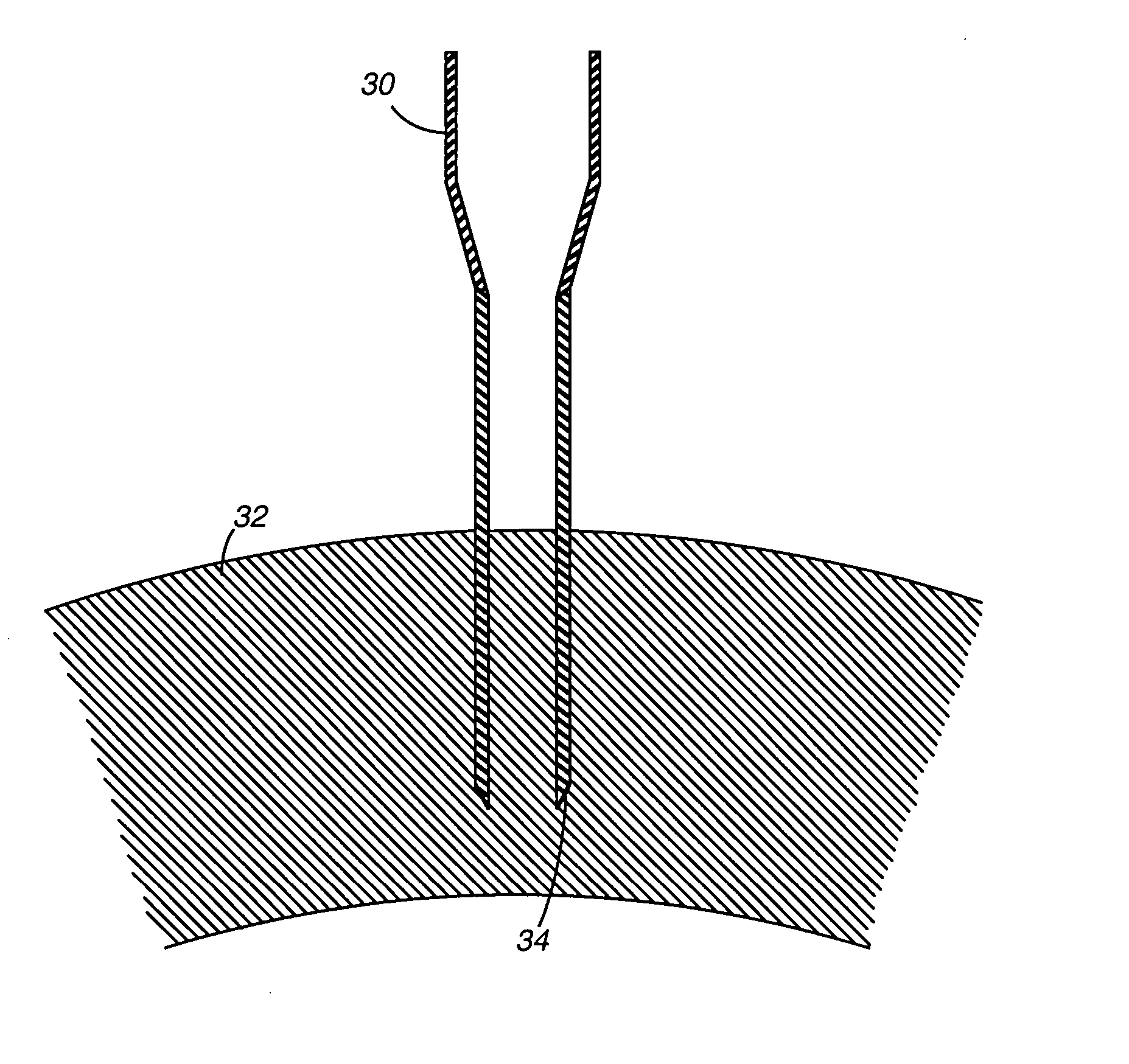 Method and apparatus for providing immediate supplemental blood flow to an organ