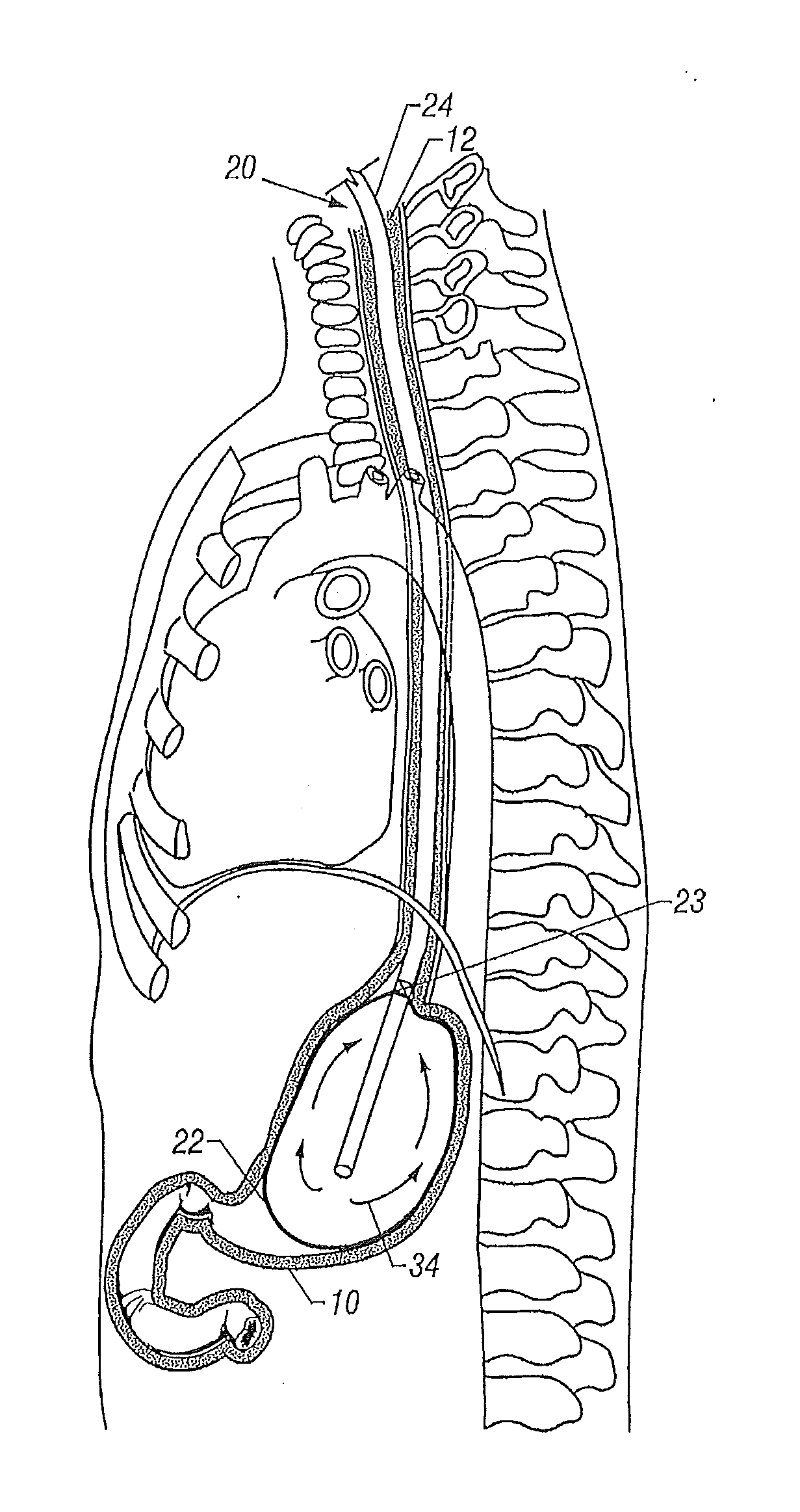 Apparatus and method for esophageal cooling