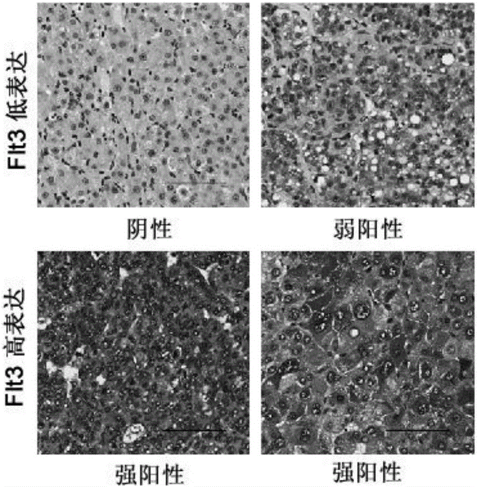 Applications of Flt3 protein in preparation of kit for evaluating liver cancer treating effect of sorafenib