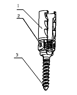 Minimally invasive composite self-tapping pedicle screw