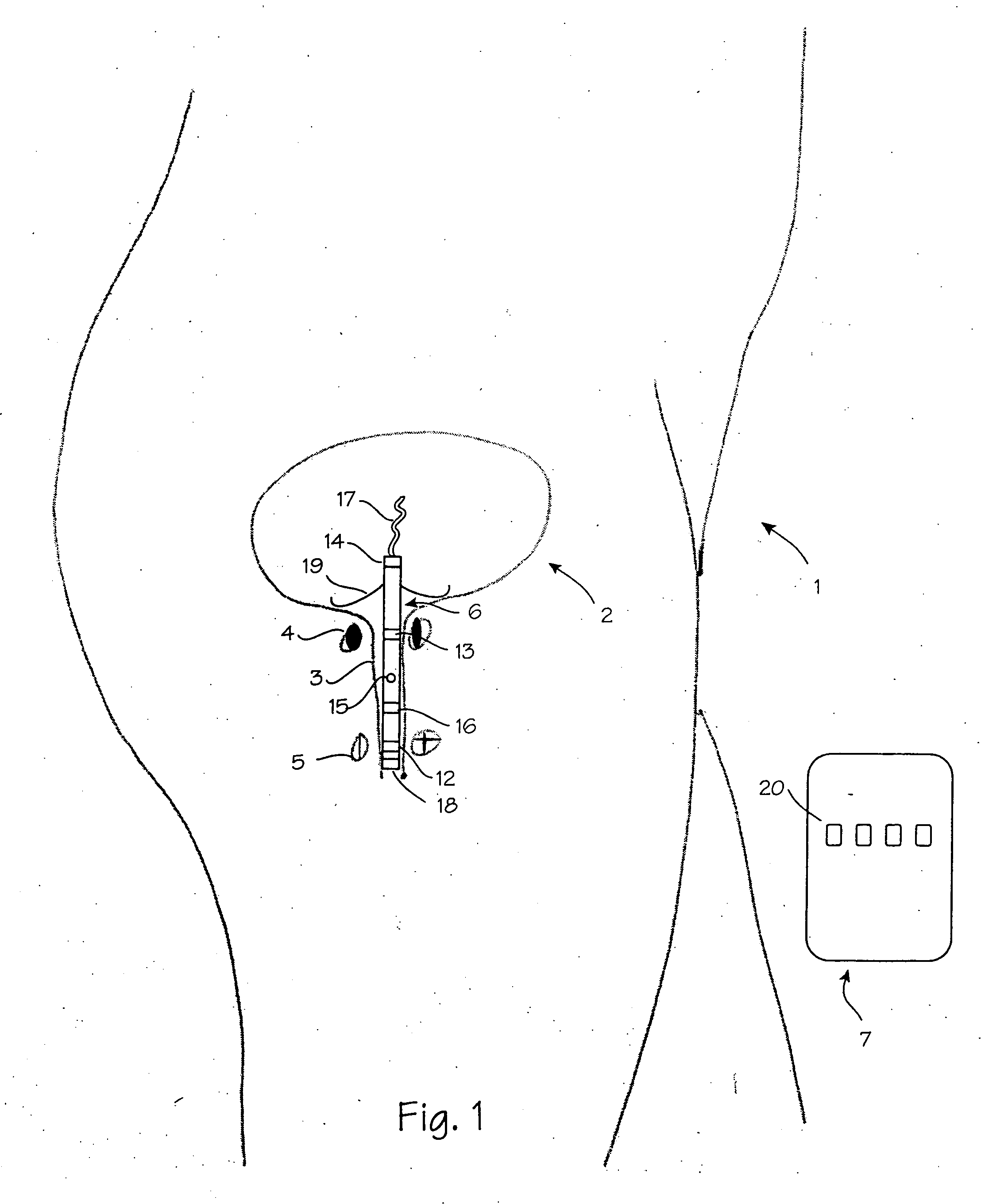 Wireless urinary incontinence monitoring system