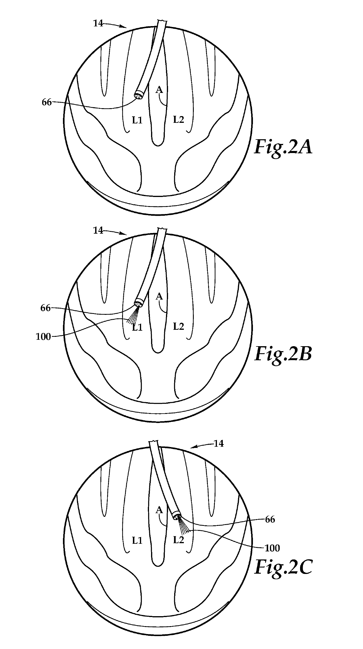 Medication delivery apparatus and accompanying system for the application of local anesthetics to a treatment site and method for use of same