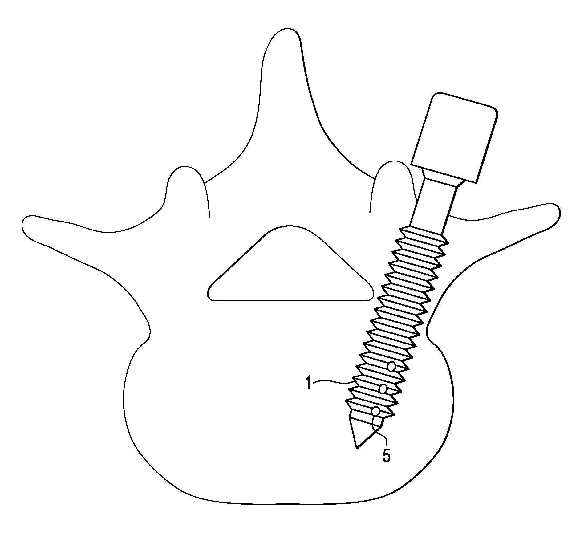 Methods and devices for correcting spinal deformity with pharmaceutical-eluting pedicle screws