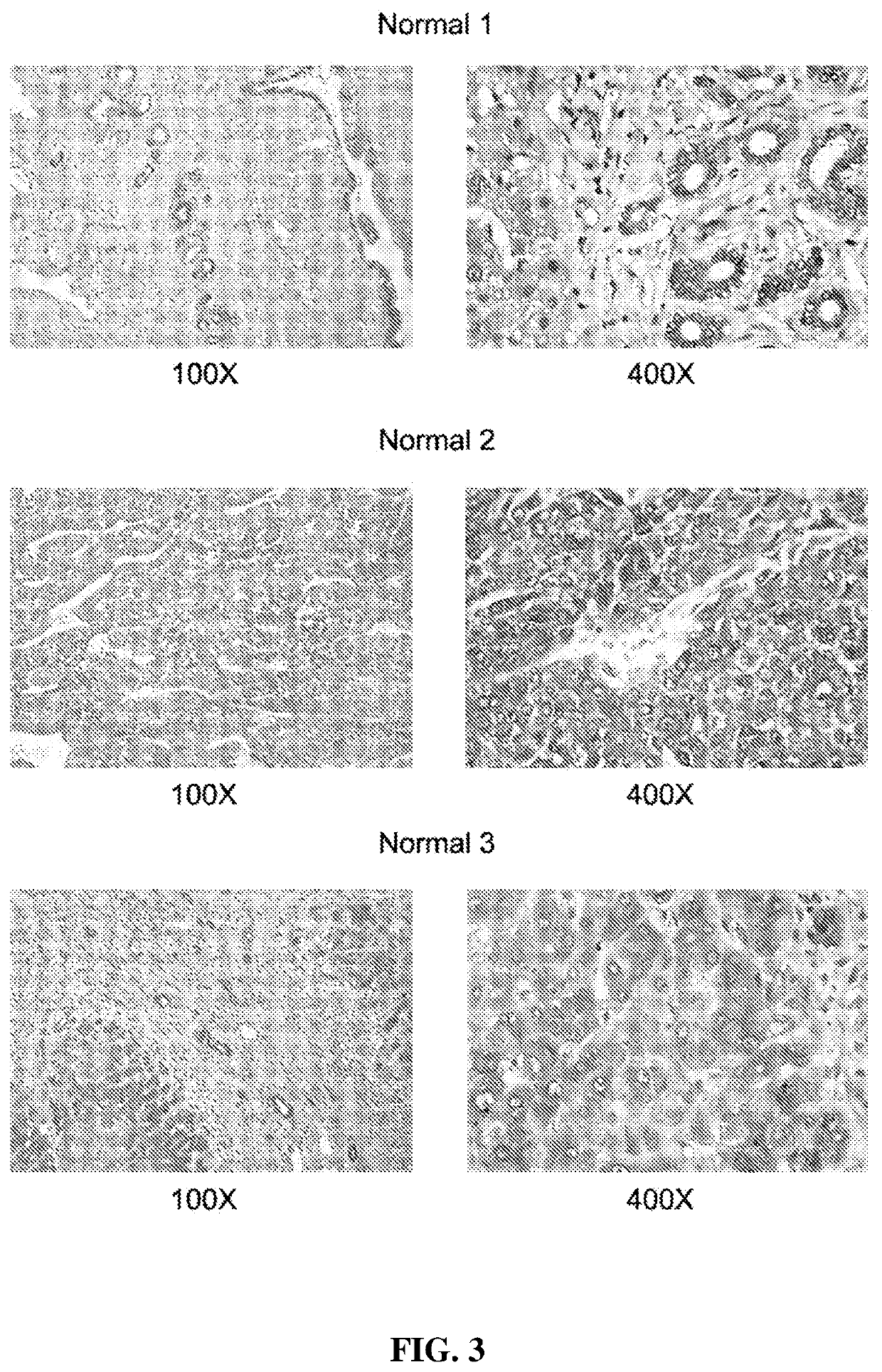 Inhibition of aminocylase 3 (AA3) in the treatment of cancer