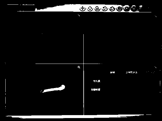 Electromagnetic sign system of bone fracture occlusion reduction treatment