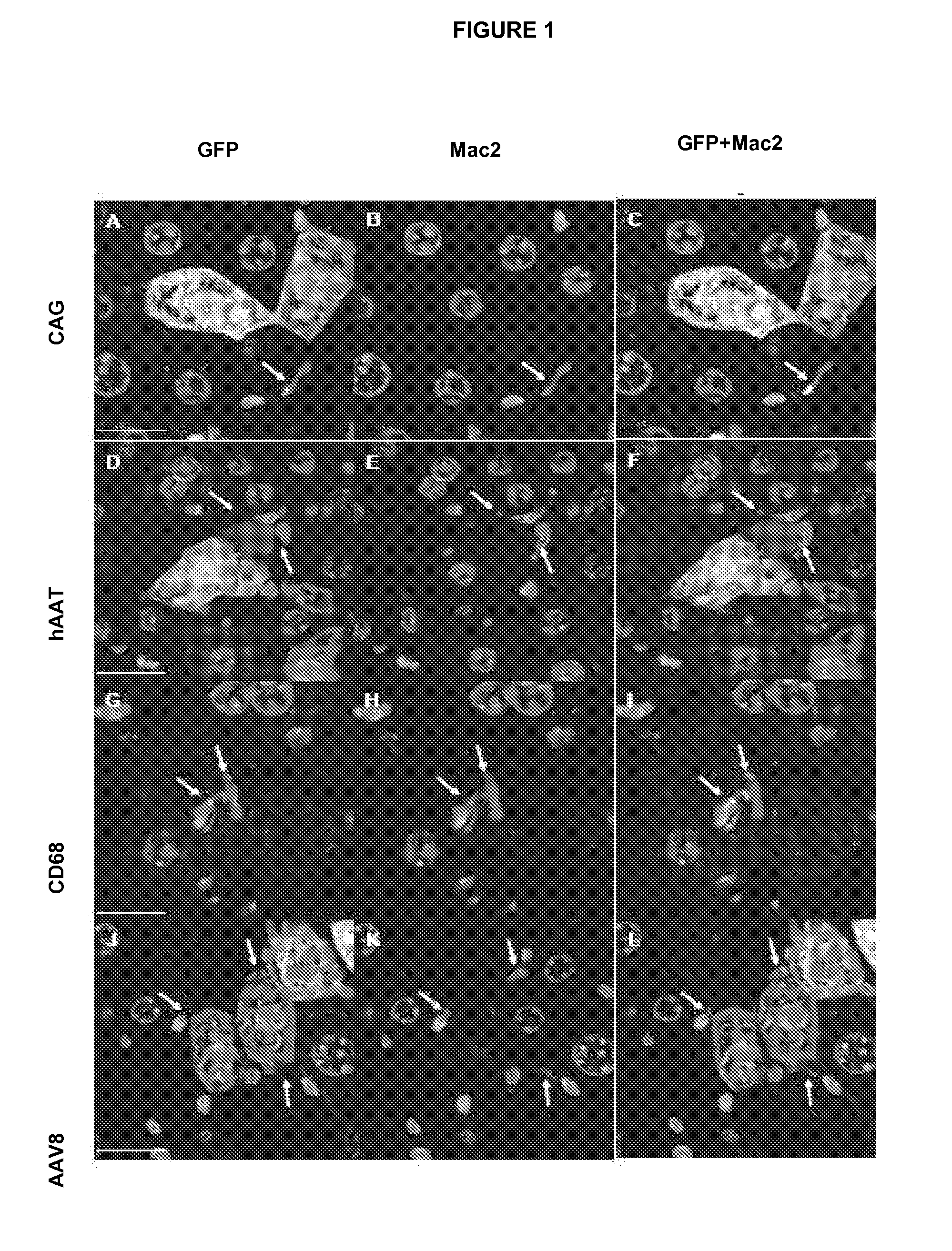 Gene therapy compositions for preventing and/or treating of autoimmune diseases