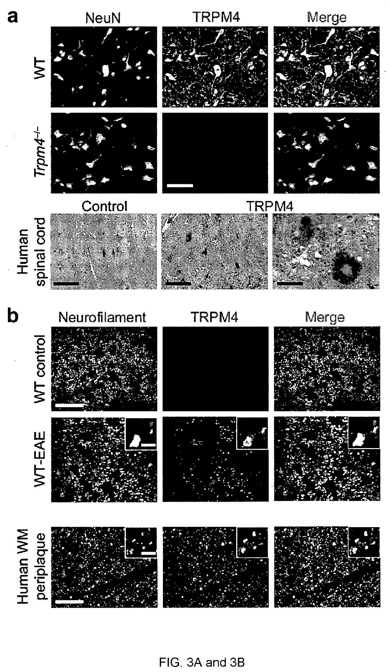 Inhibitor of trpm-4 ion channel for treating or preventing neurodegeneration