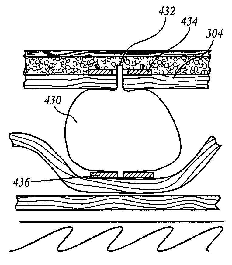 Extragastric devices and methods for gastroplasty