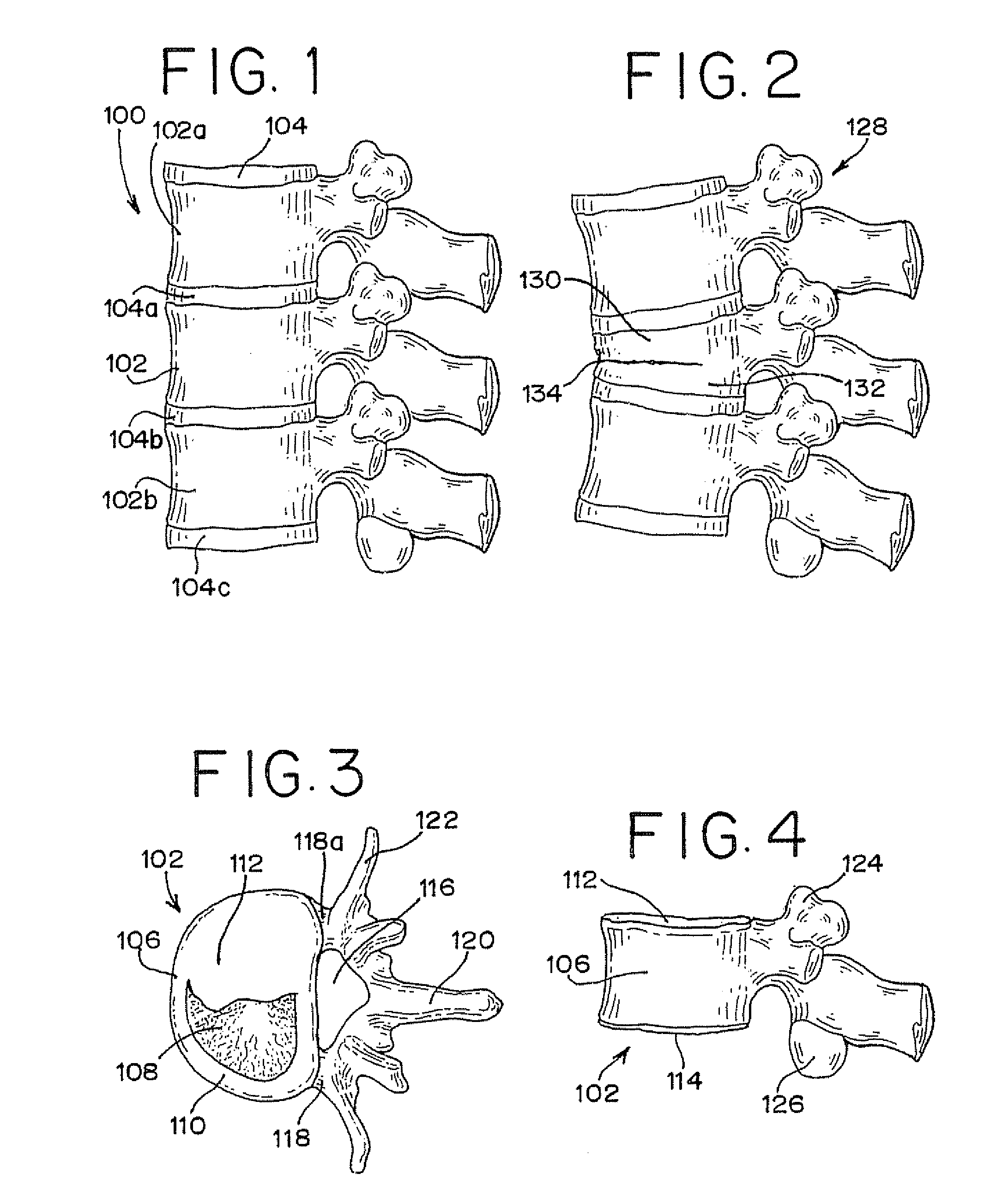 Methods for Limiting the Movement of Material Introduced Between Layers of Spinal Tissue