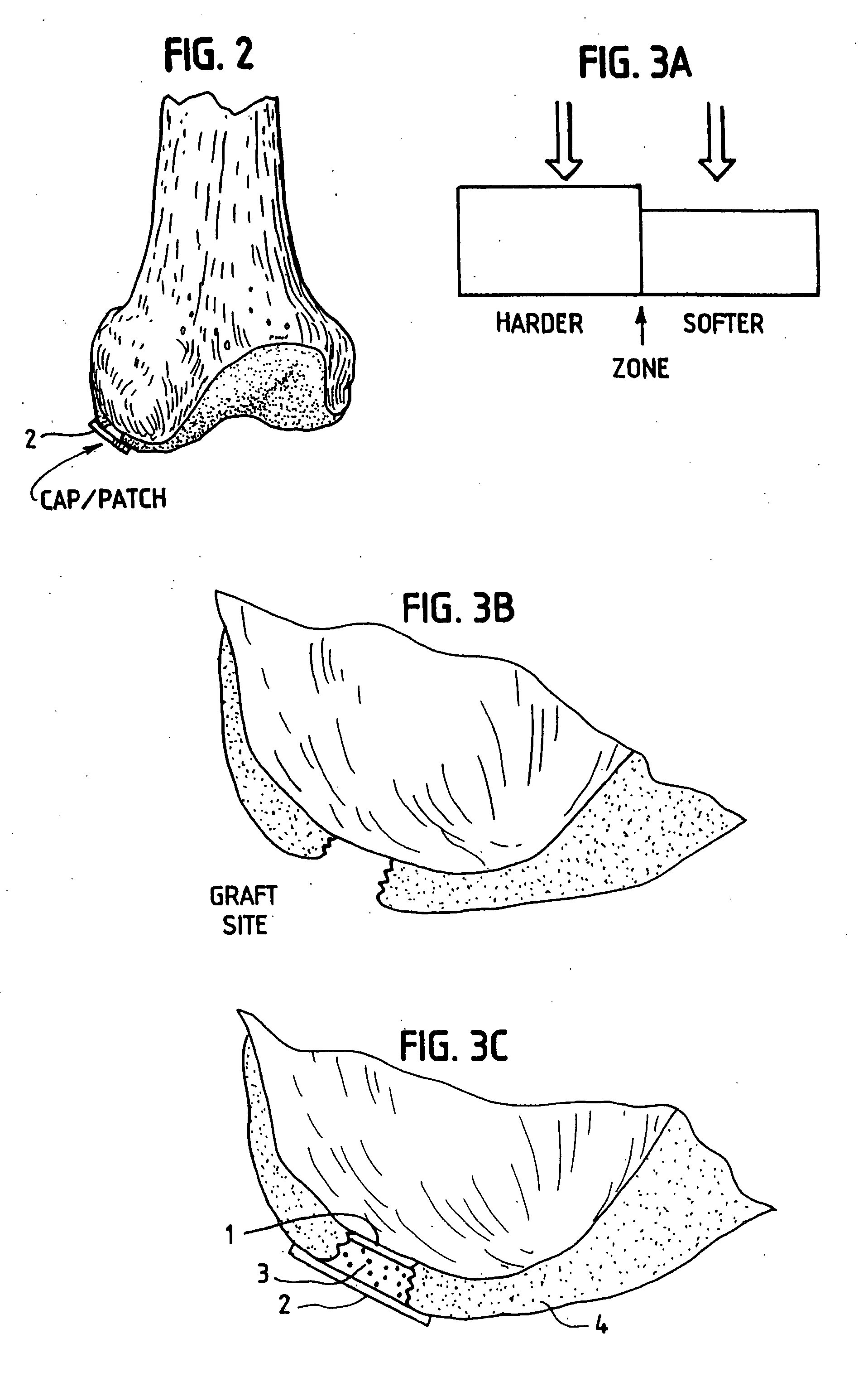 Method, instruments, and kit for autologous transplantation