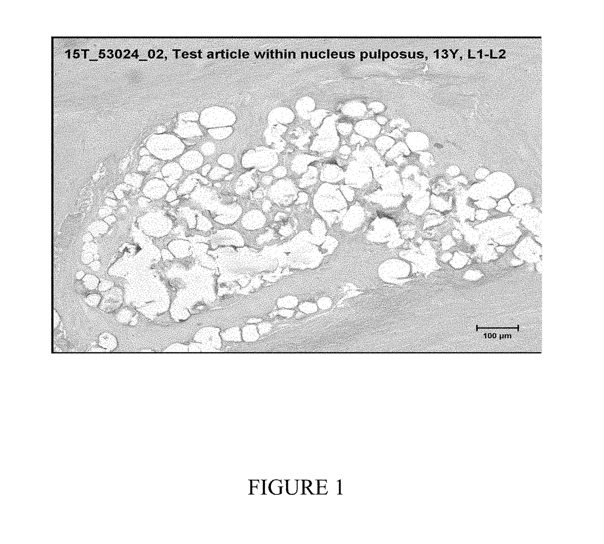 Method of treating spinal disk