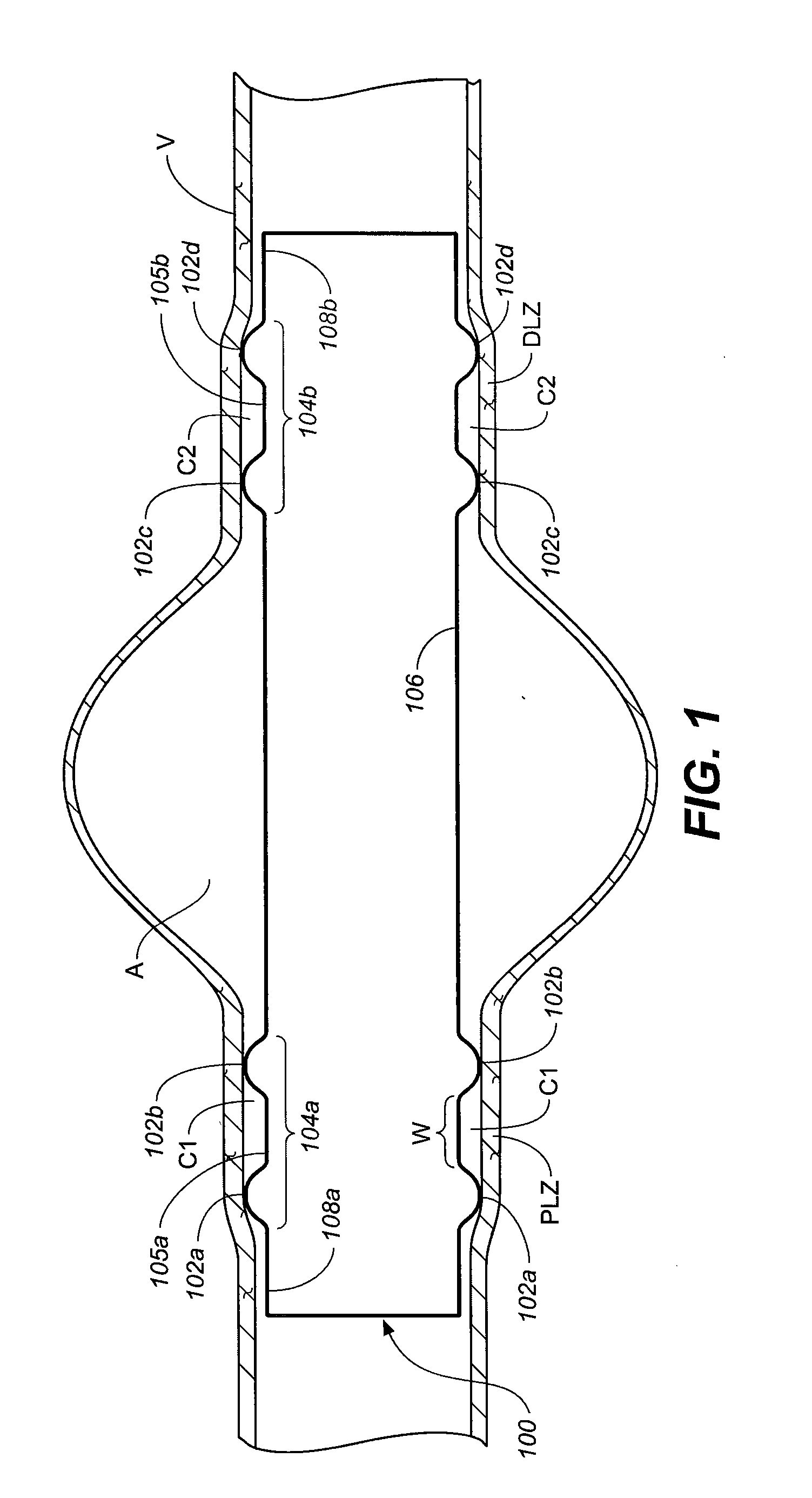 Prosthesis With Coupling Zone and Methods