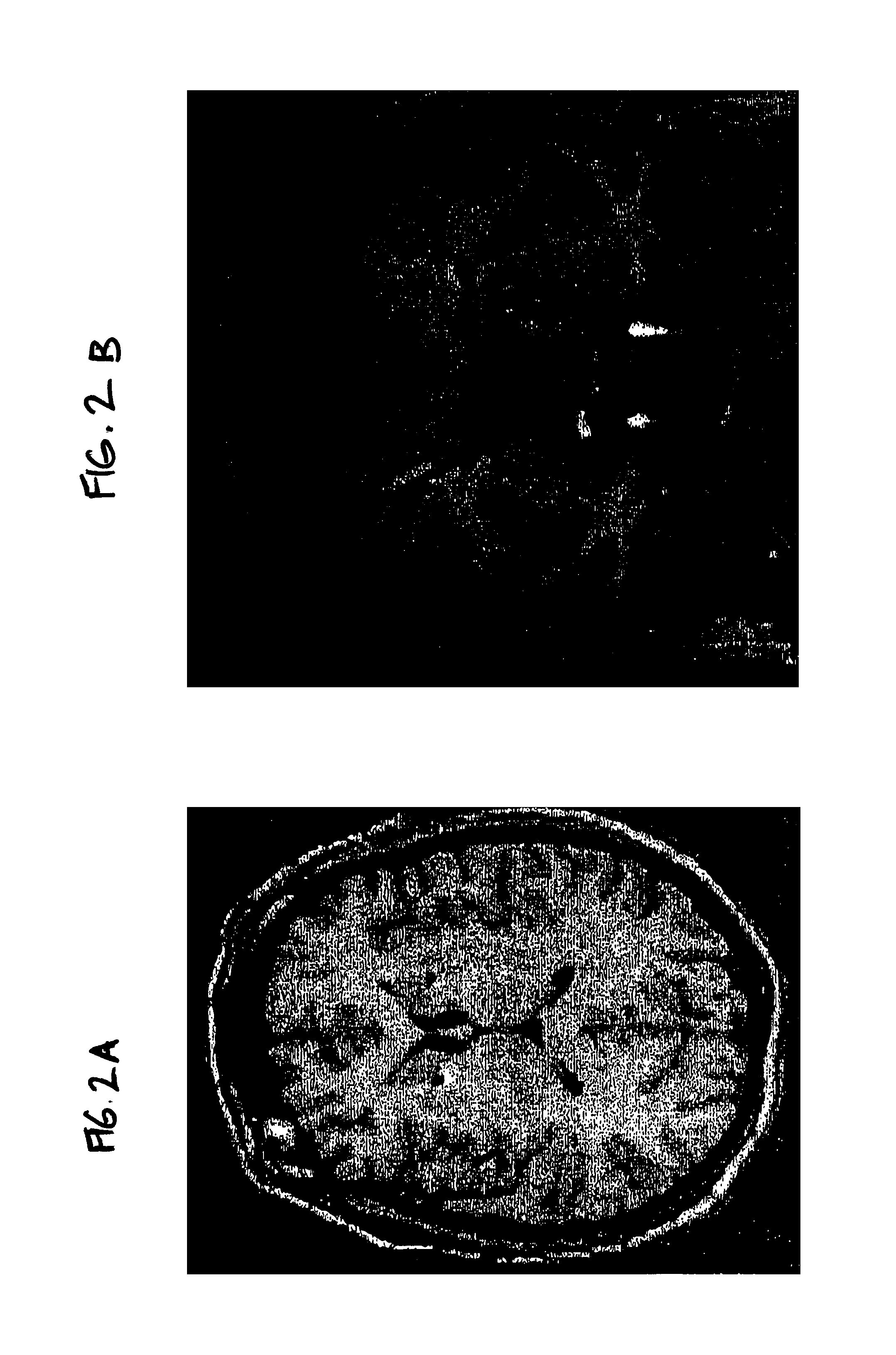 Method for treating obsessive-compulsive disorder with electrical stimulation of the brain internal capsule