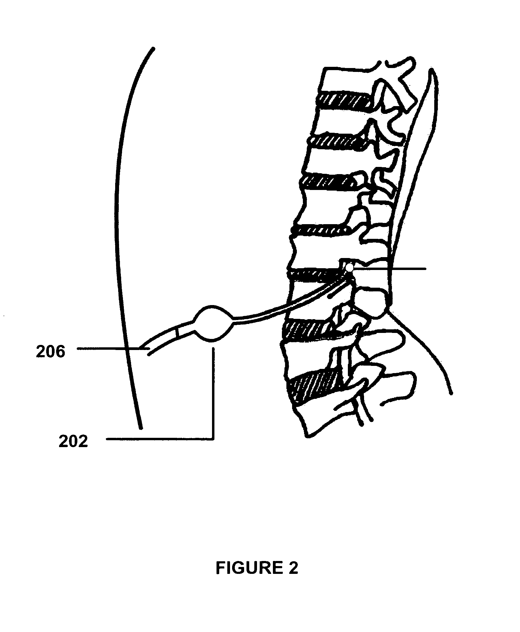 Method and apparatus for removing harmful proteins from a mammalian's ventricular cerebrospinal fluid
