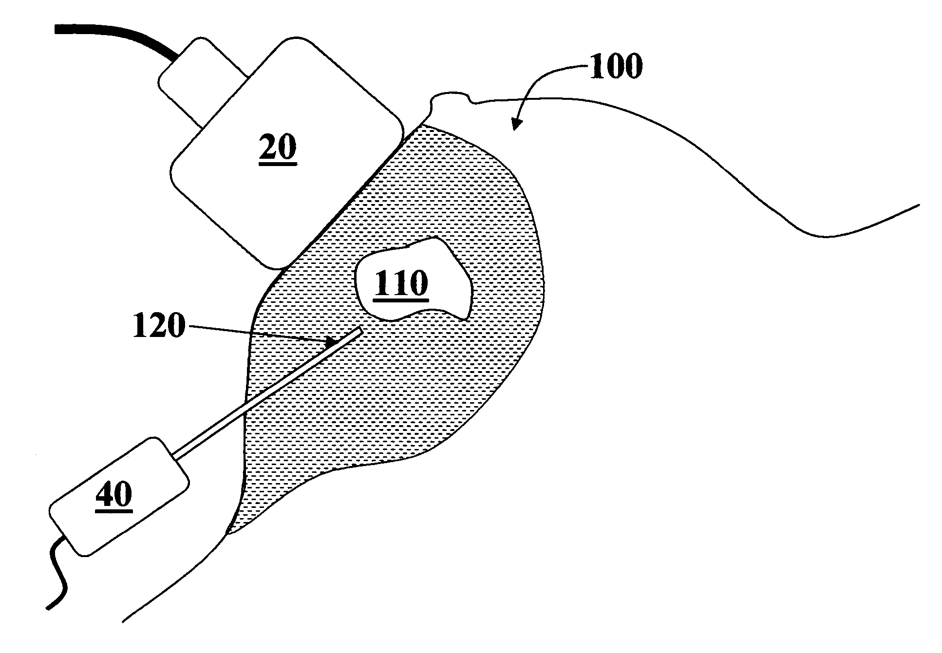 Ultrasound guided tissue measurement system