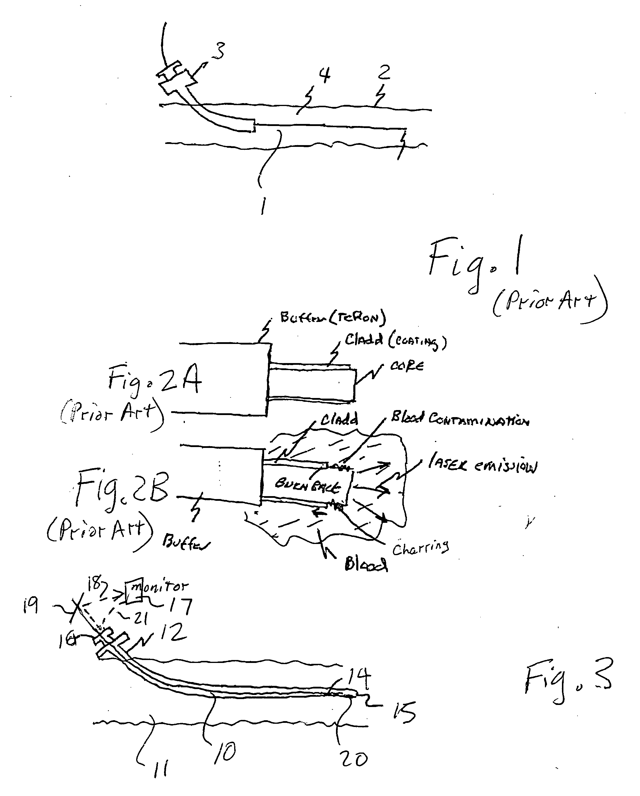 Endovascular method and apparatus with electrical feedback