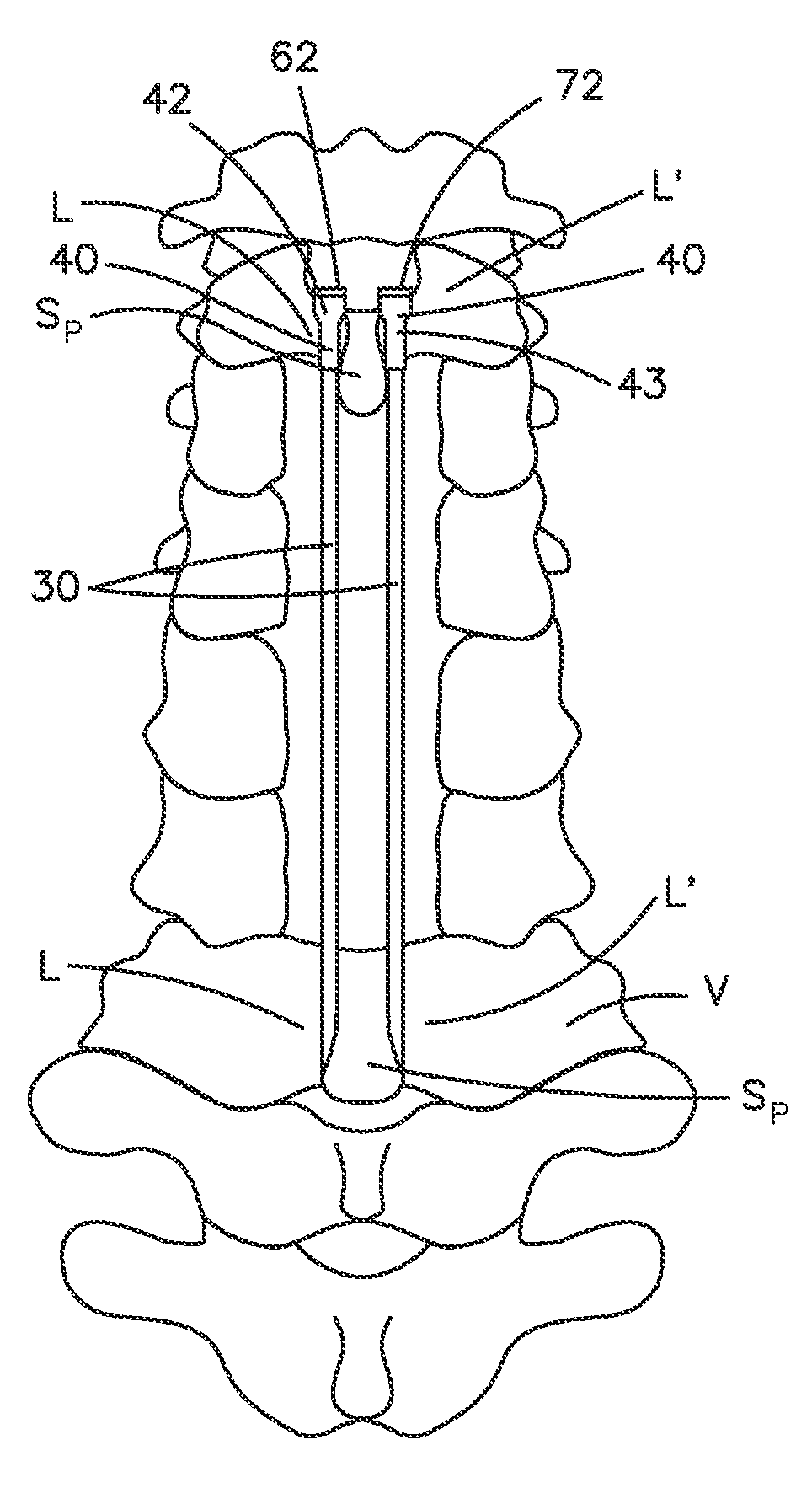 Spine stabilization system and method