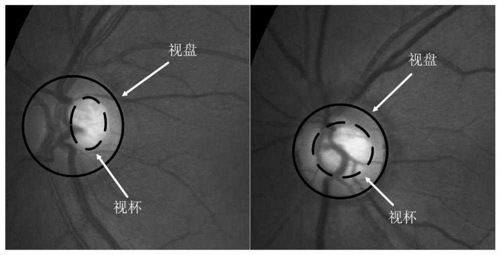 A Method of Optic Cup and Disc Segmentation Based on Fundus Map Dataset Transfer Learning