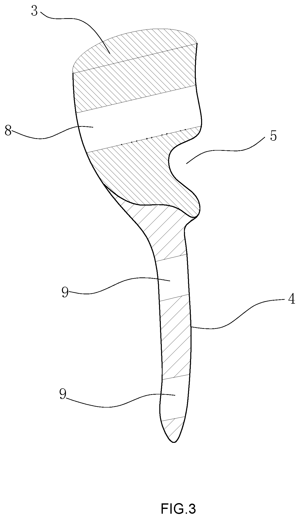 Semi-Radial Head Prosthesis