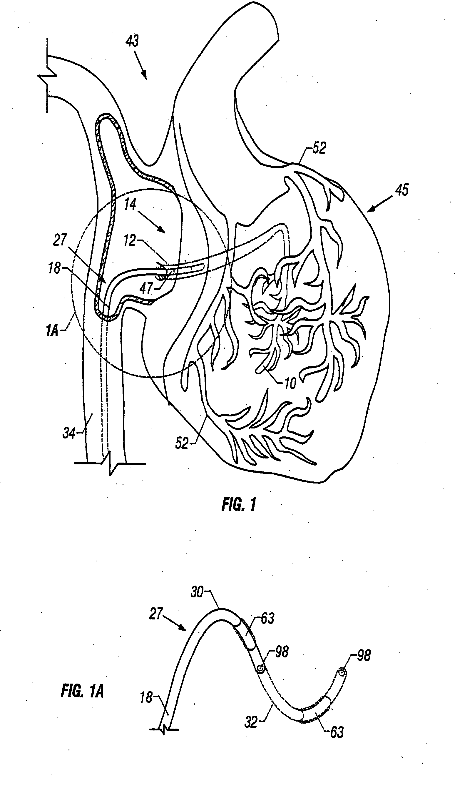Method and apparatus to remove substances from vessels of the heart and other parts of the body to minimize or avoid renal or other harm or dysfunction