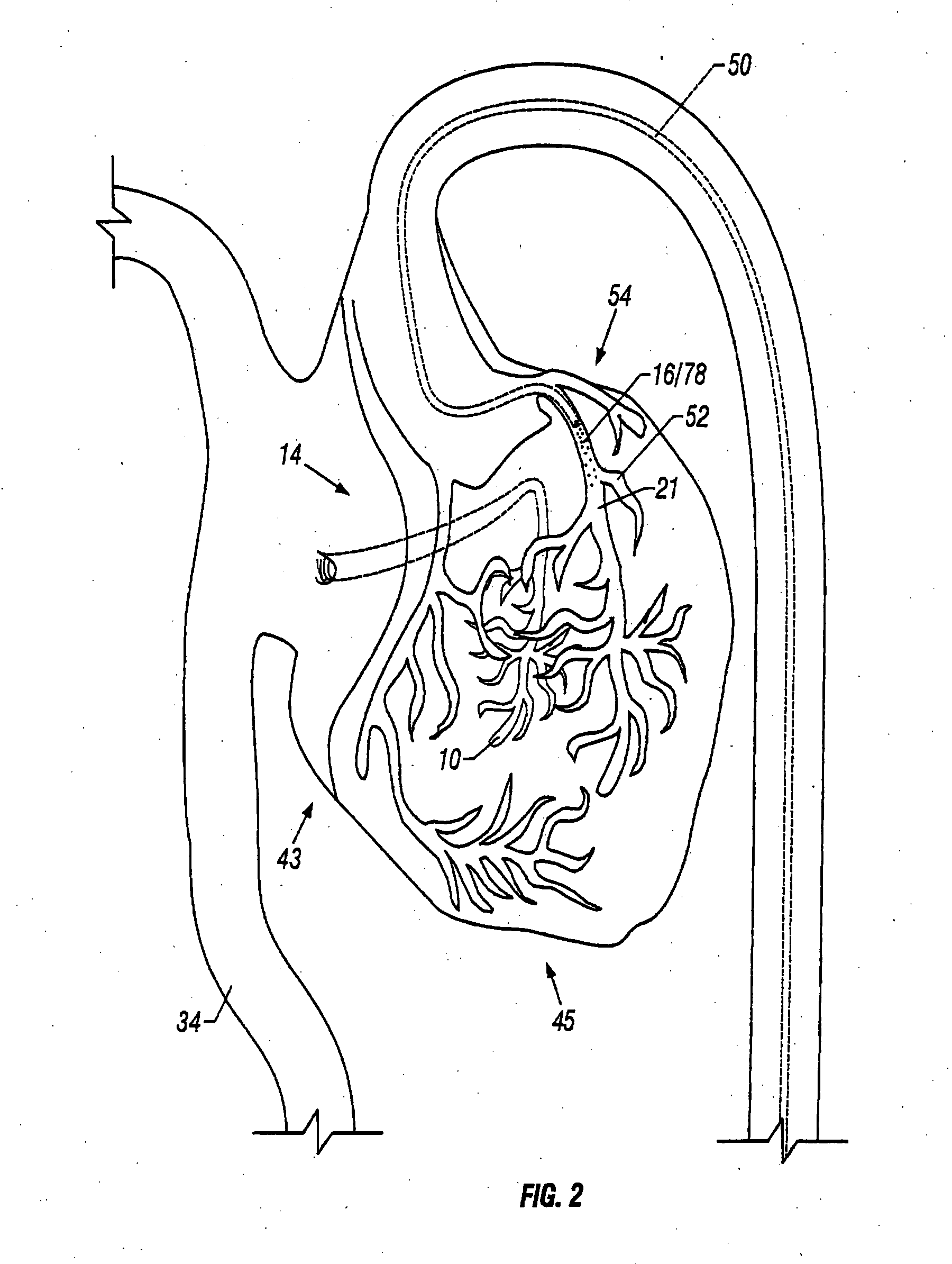 Method and apparatus to remove substances from vessels of the heart and other parts of the body to minimize or avoid renal or other harm or dysfunction
