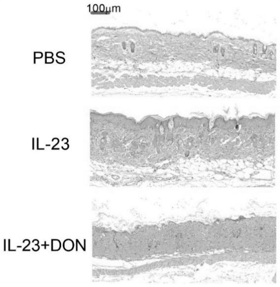 Application of 6-diazo-5-oxo-L-leucine in preparation of drugs for preventing and treating psoriasis