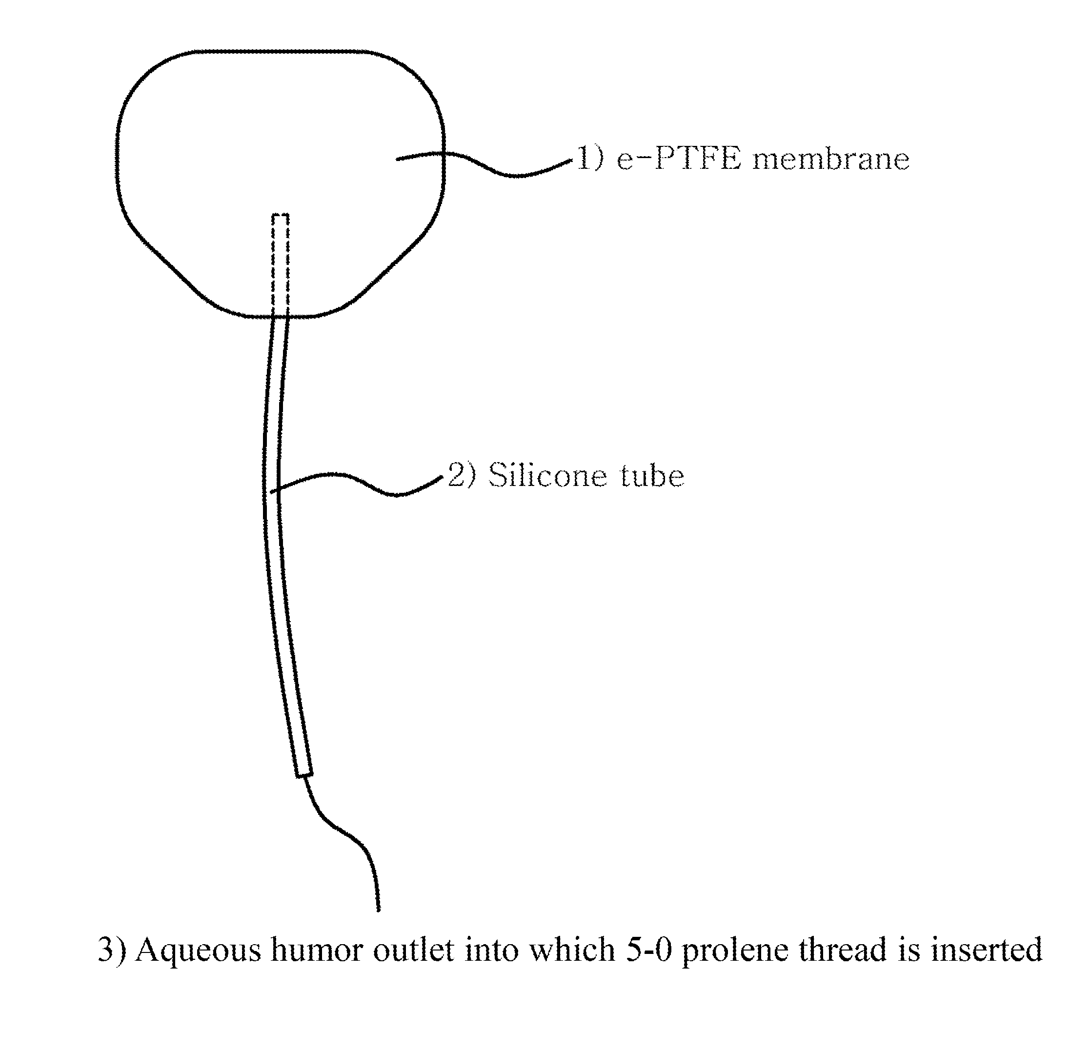 Device for treating ocular diseases caused by increased intraocular pressure