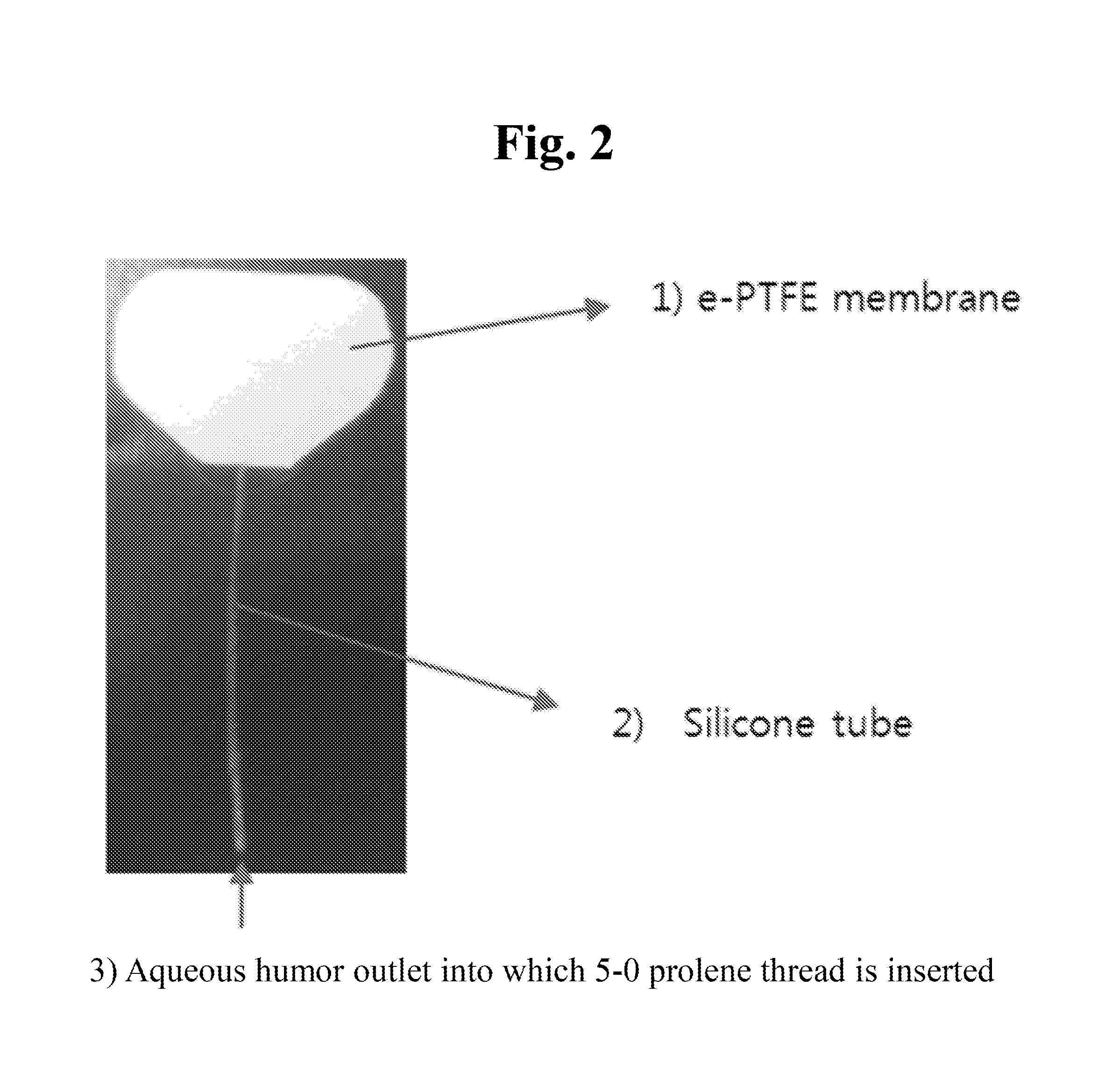 Device for treating ocular diseases caused by increased intraocular pressure