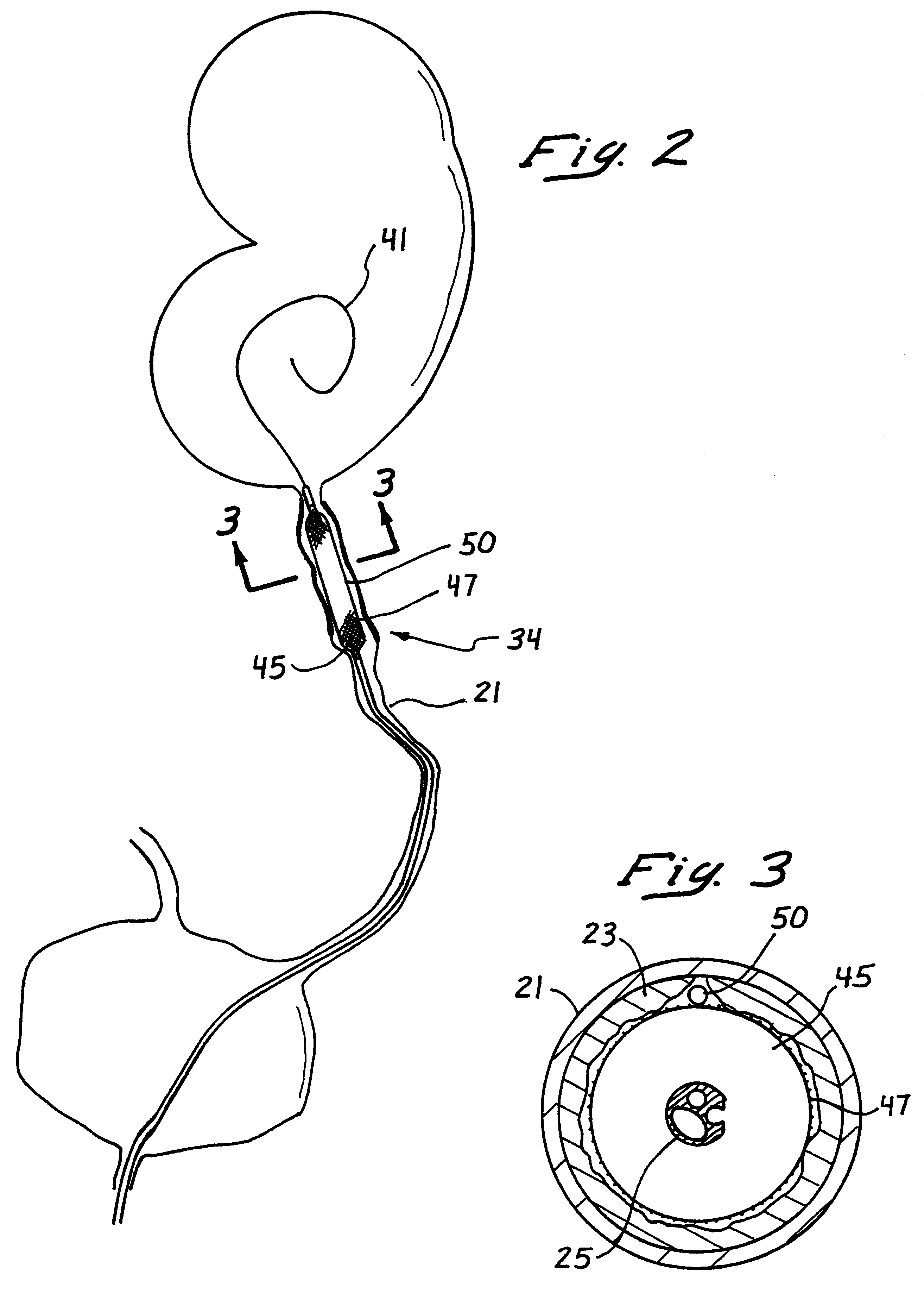 Electrosurgical catheter apparatus and method