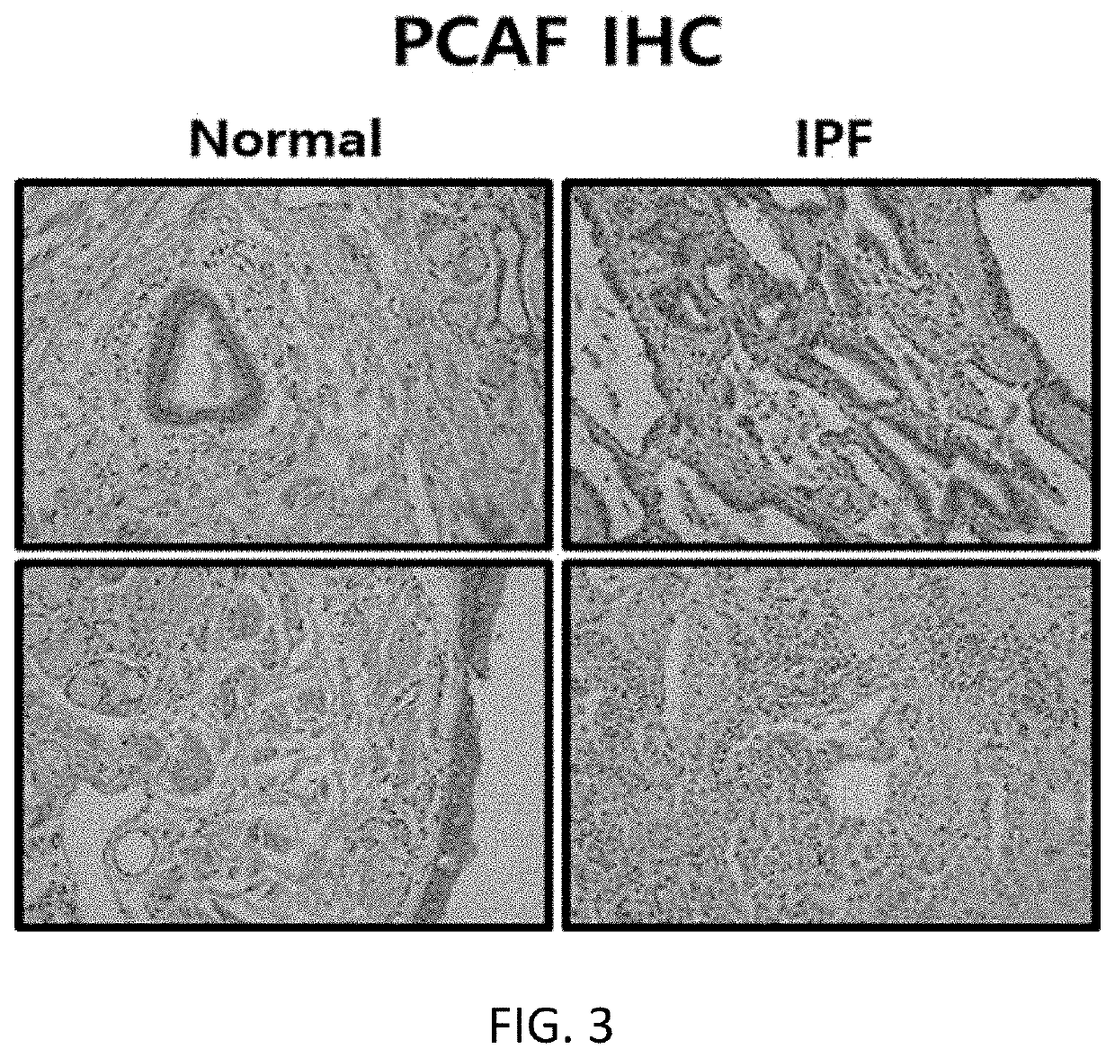 Novel compound for inhibiting histone acetyltransferase p300 and antifibrotic composition comprising same