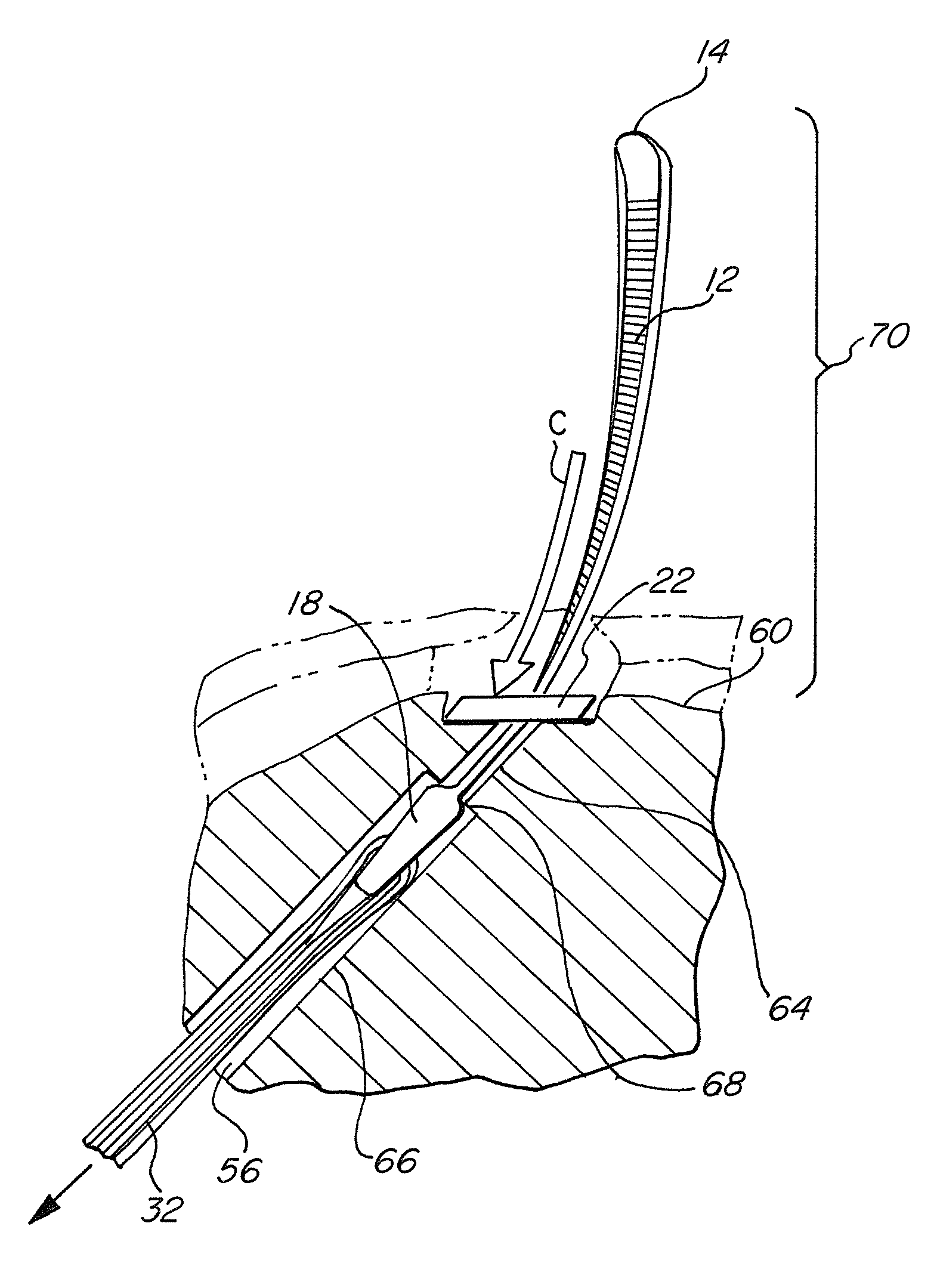 Method And Device For The Fixation Of A Tendon Graft