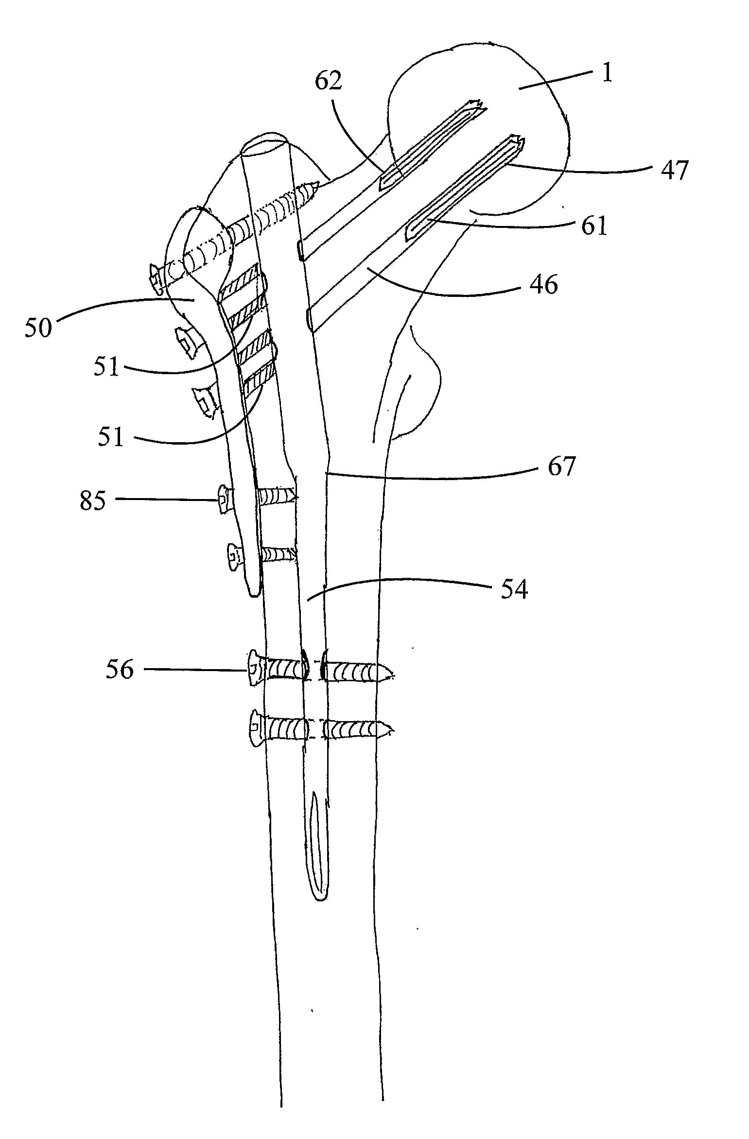Implant assembly for proximal femoral fracture