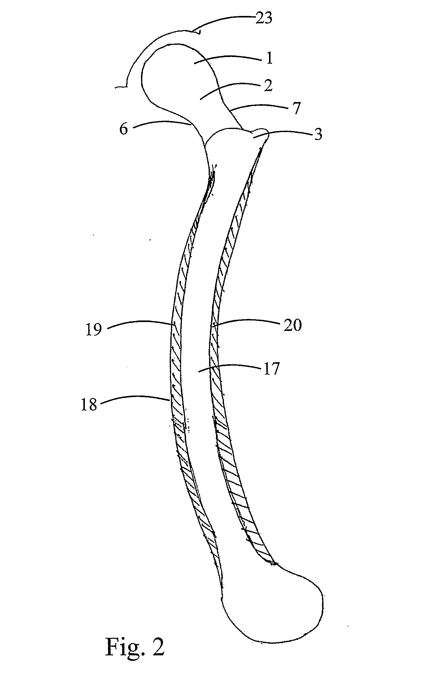 Implant assembly for proximal femoral fracture