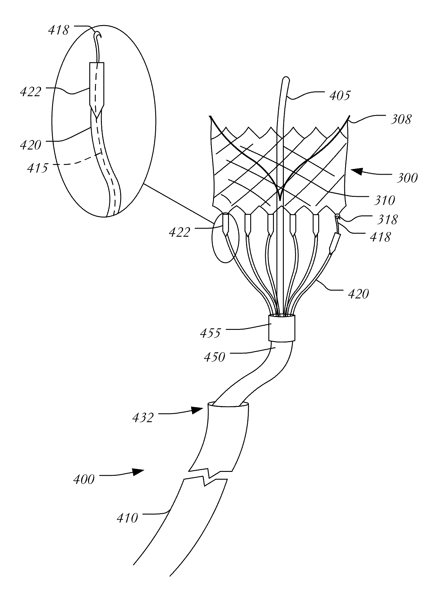Transapical Mitral Valve Replacement