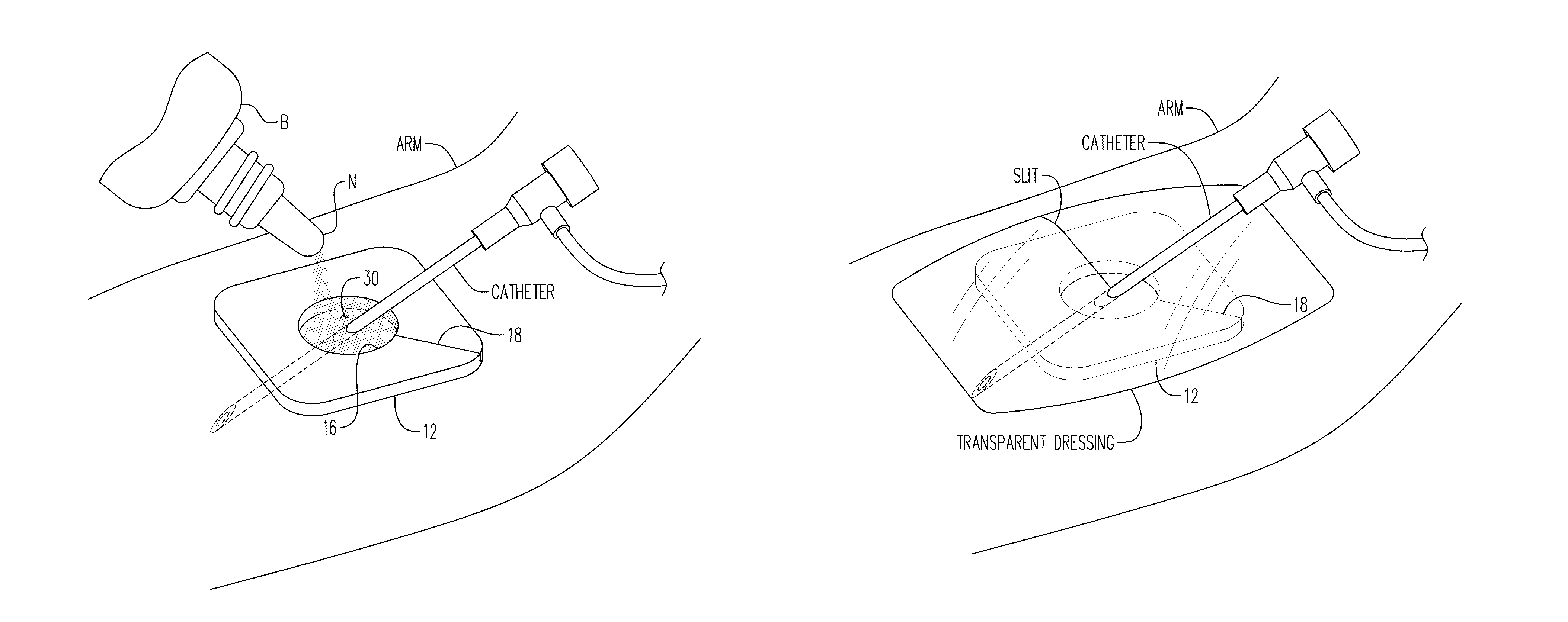 Method of reducing infections and/or air embolisms associated with vascular access procedures