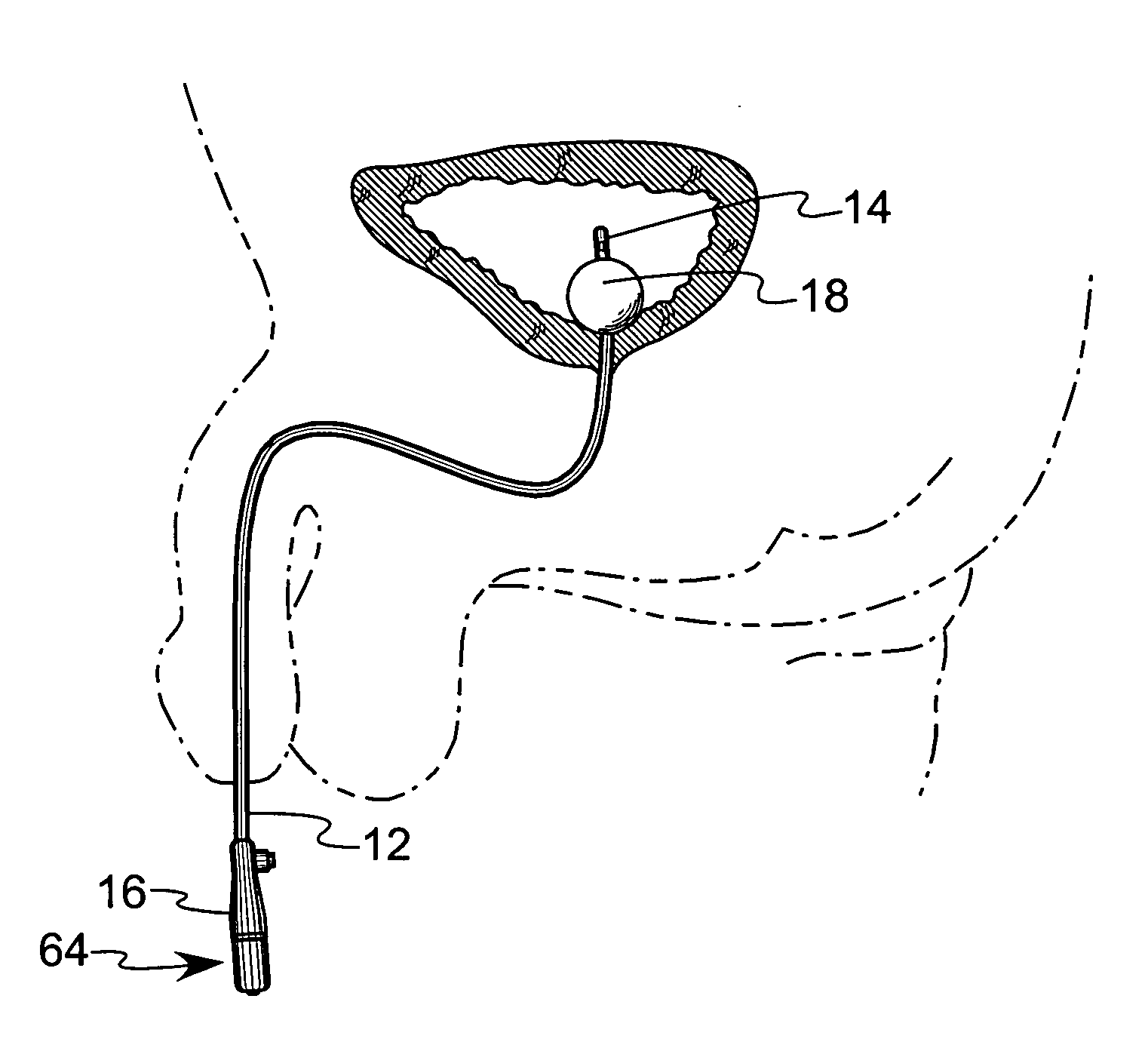 Urinary catheter