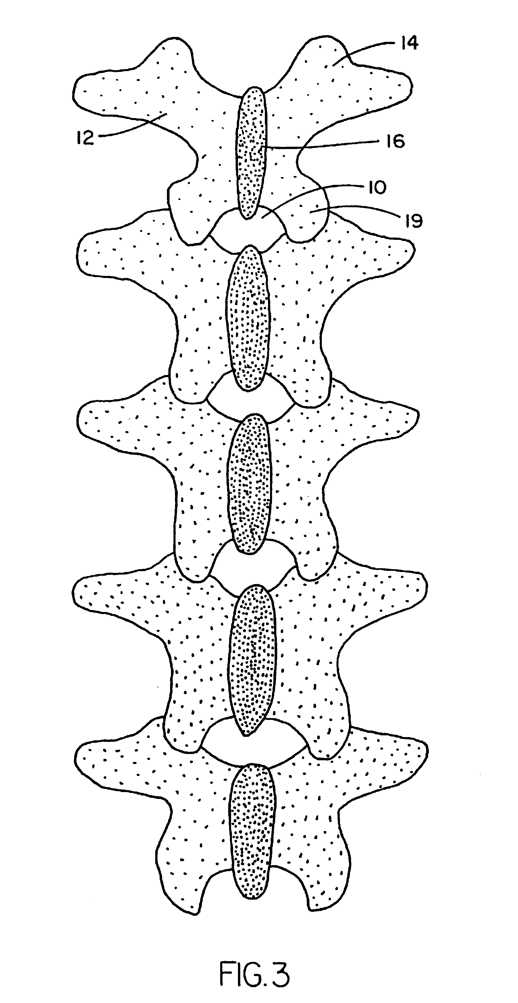 Polyaxial pedicle screw having a threaded and tapered compression locking mechanism