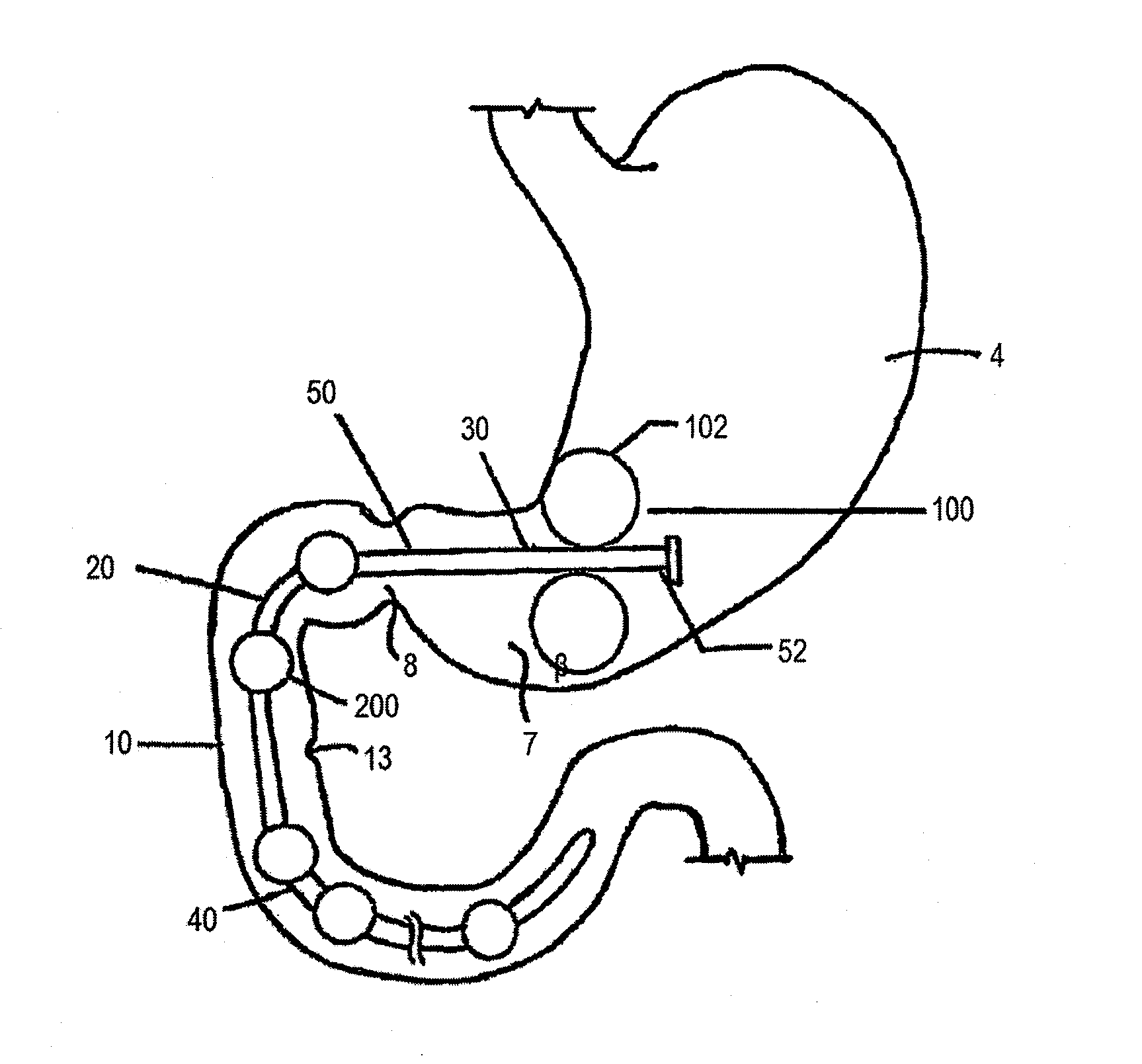 Duodenal gastrointestinal devices and related treatment methods