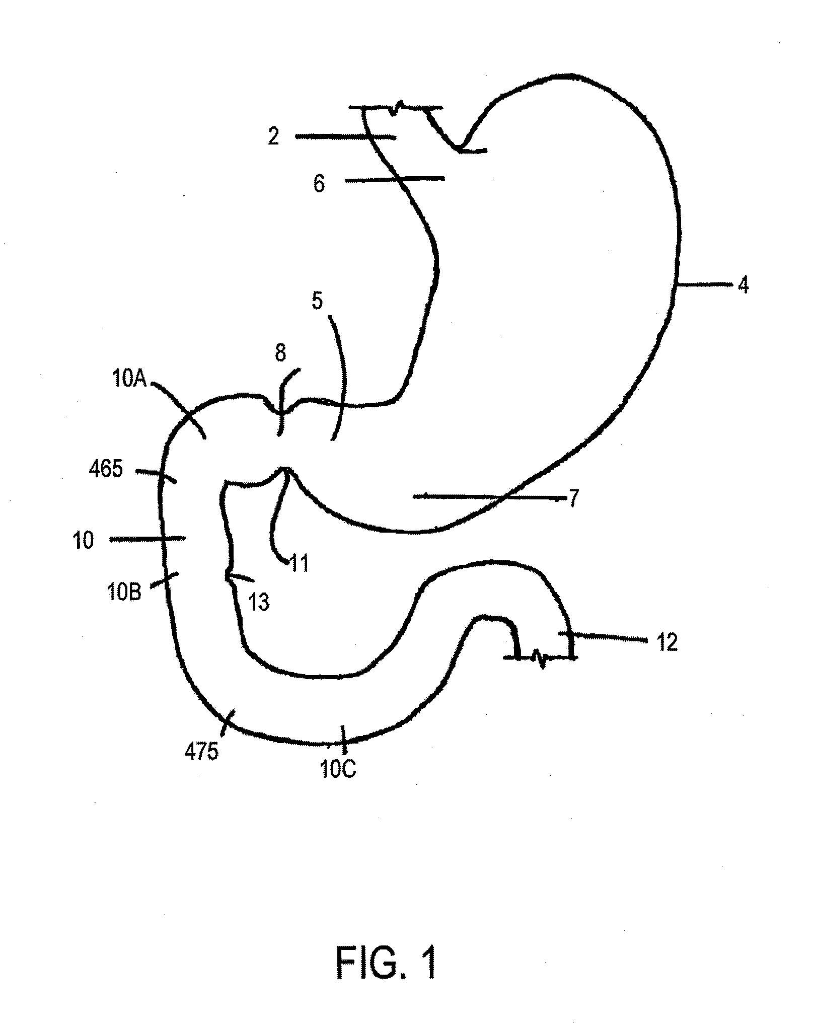 Duodenal gastrointestinal devices and related treatment methods