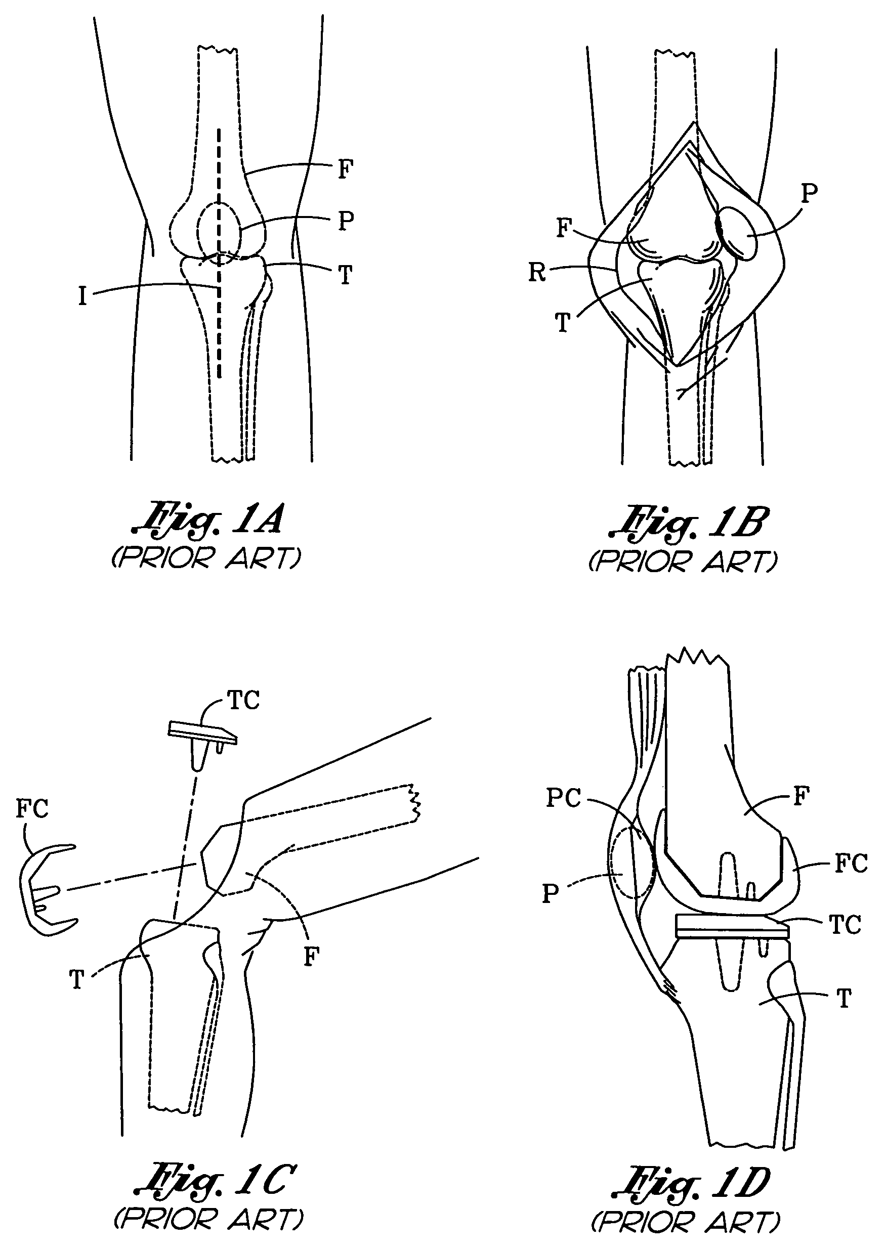 Patellar cutting guide