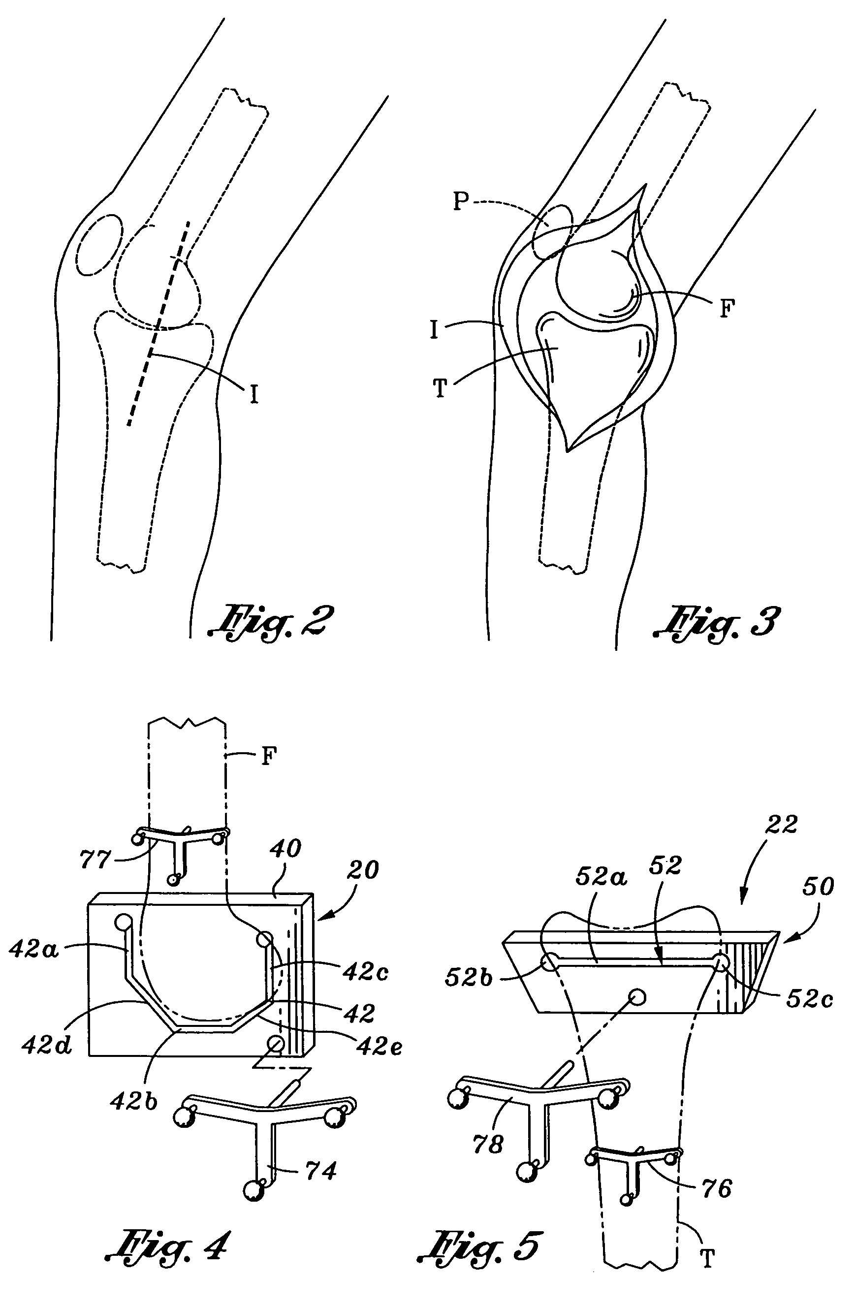 Patellar cutting guide