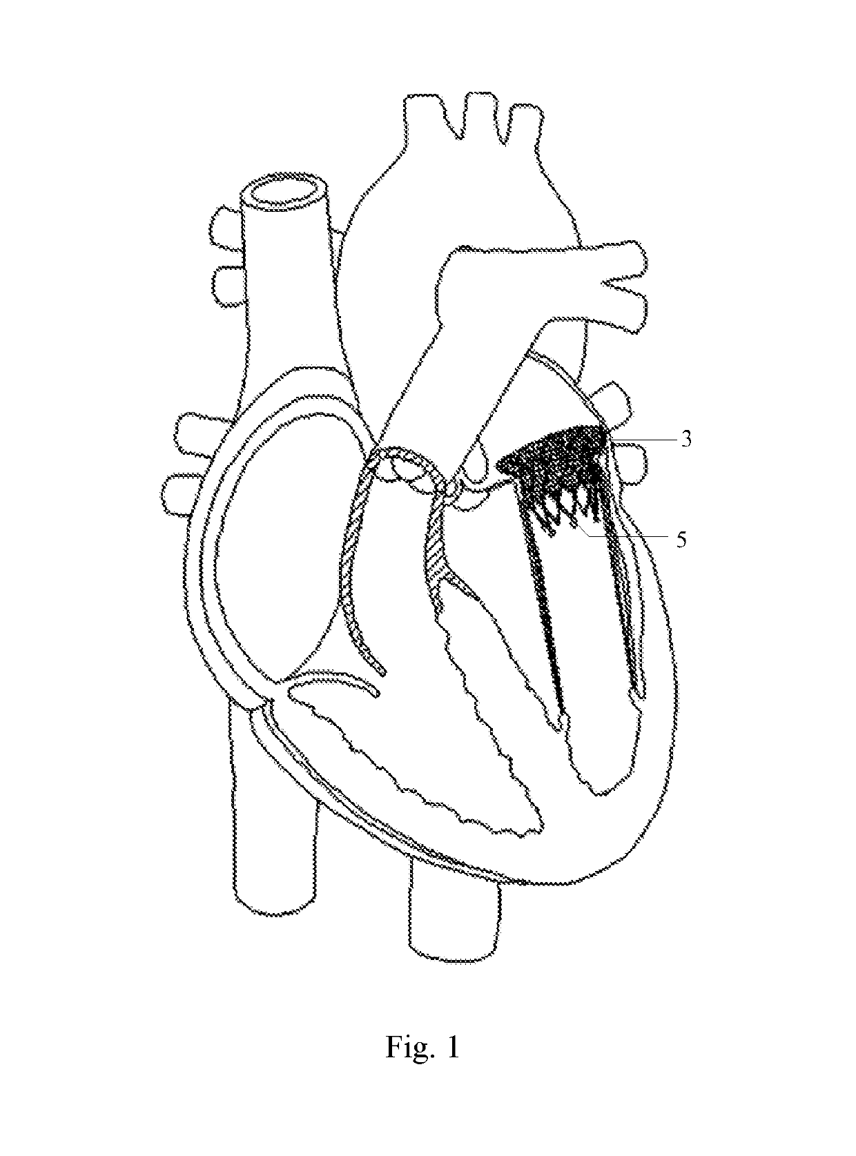 Artificial cardiac valve