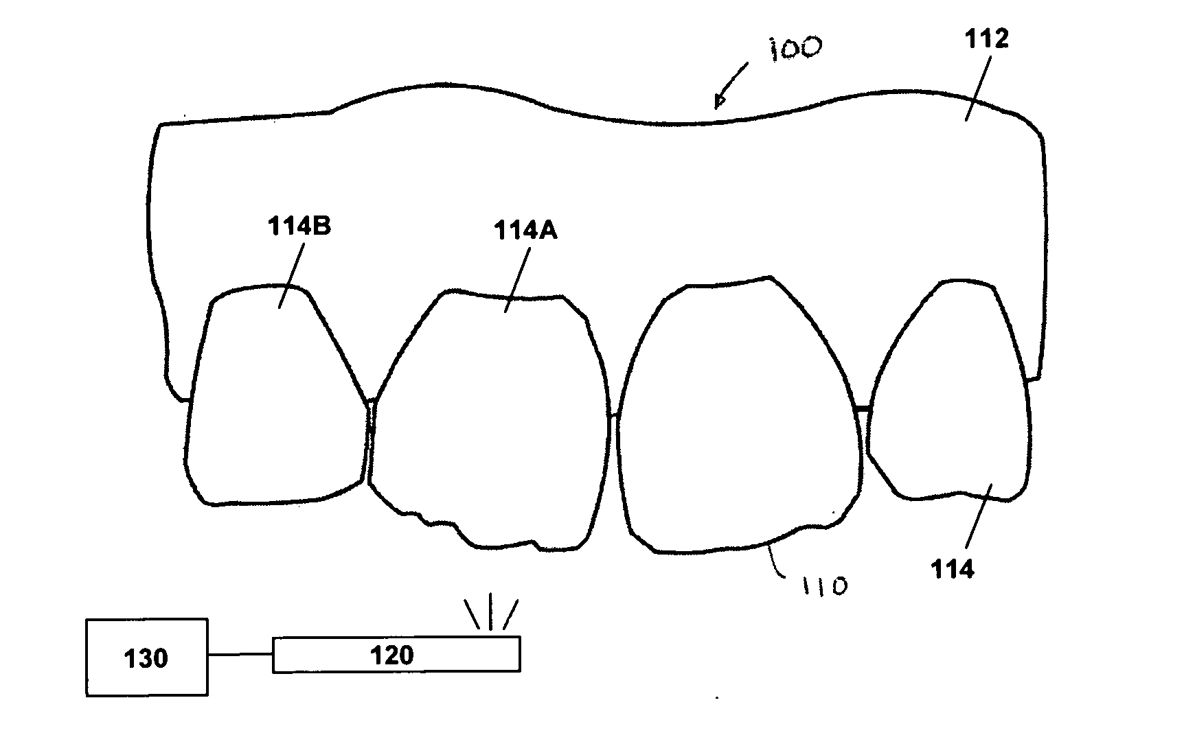 Method for dental restoration and related kit