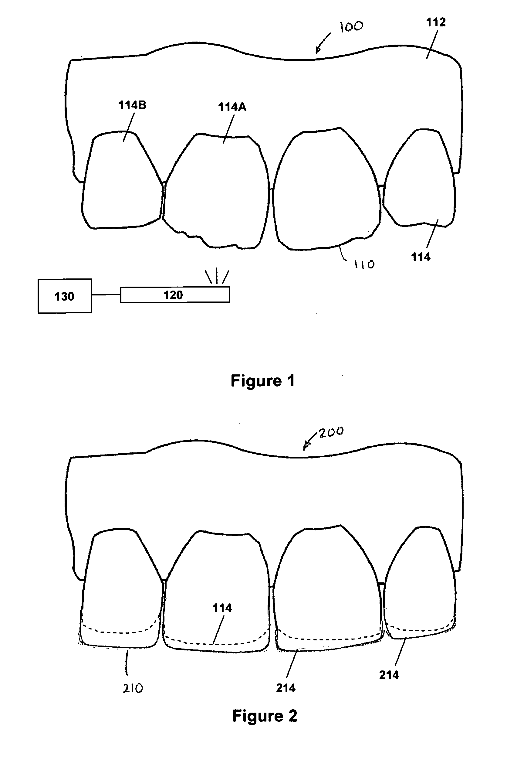 Method for dental restoration and related kit