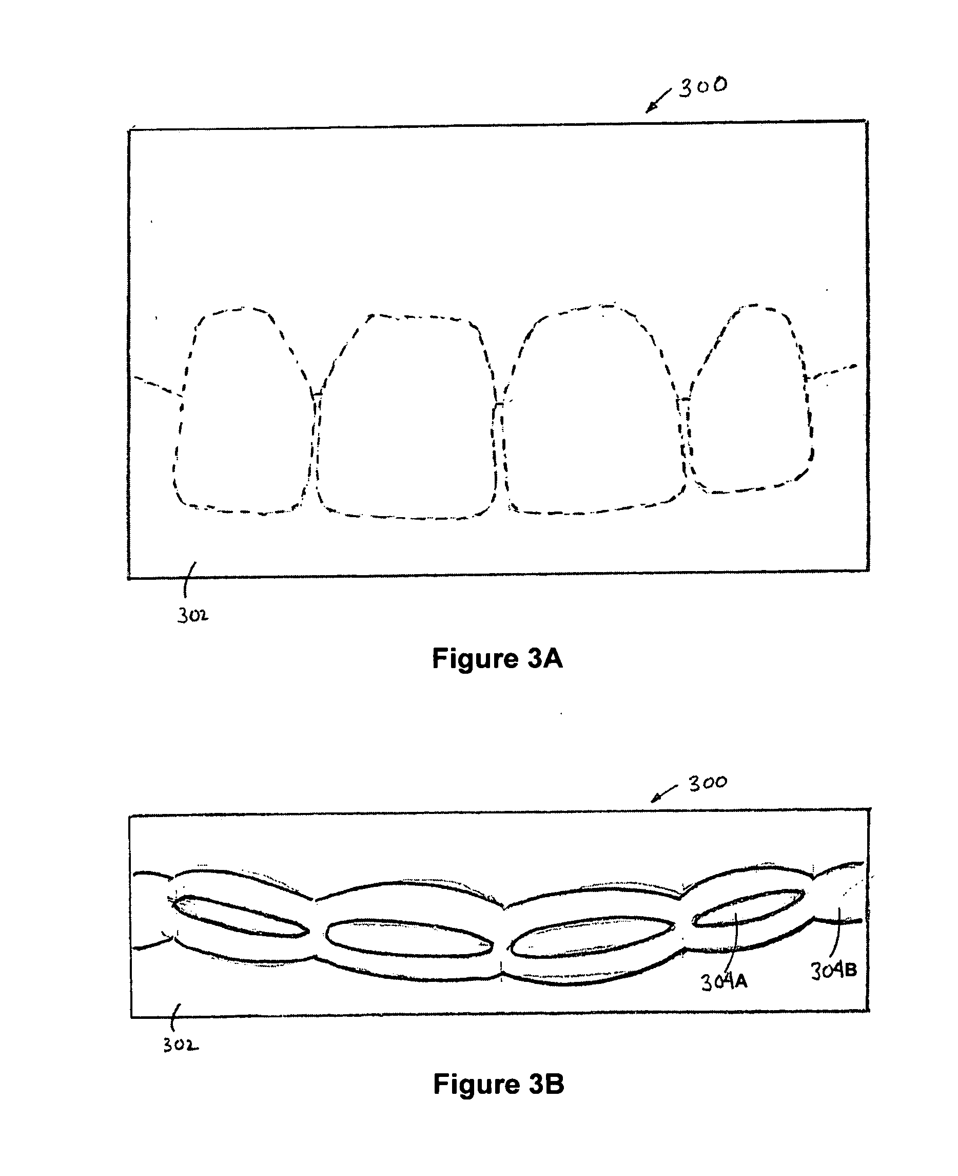 Method for dental restoration and related kit