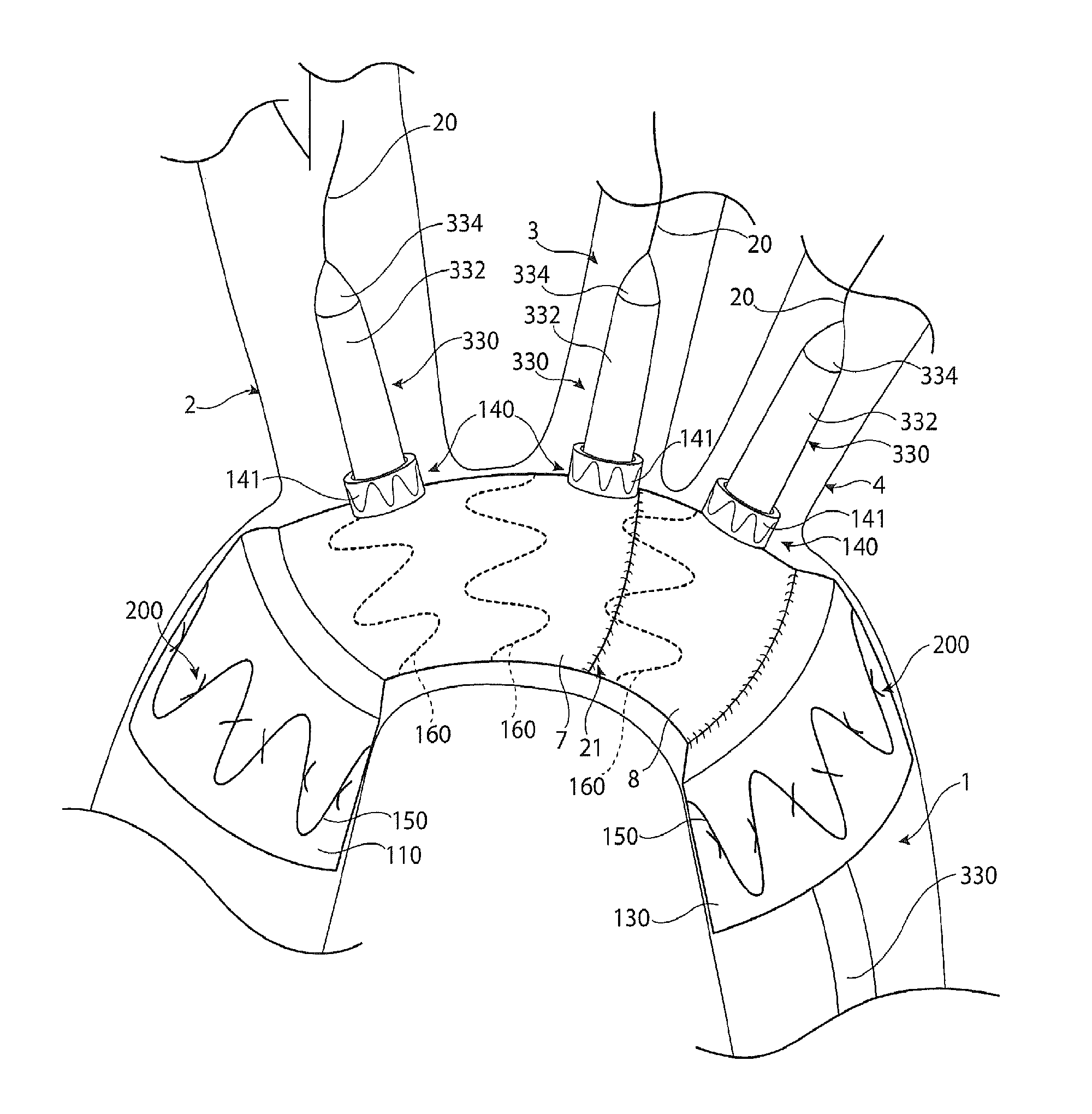 Medical device delivery system and deployment method