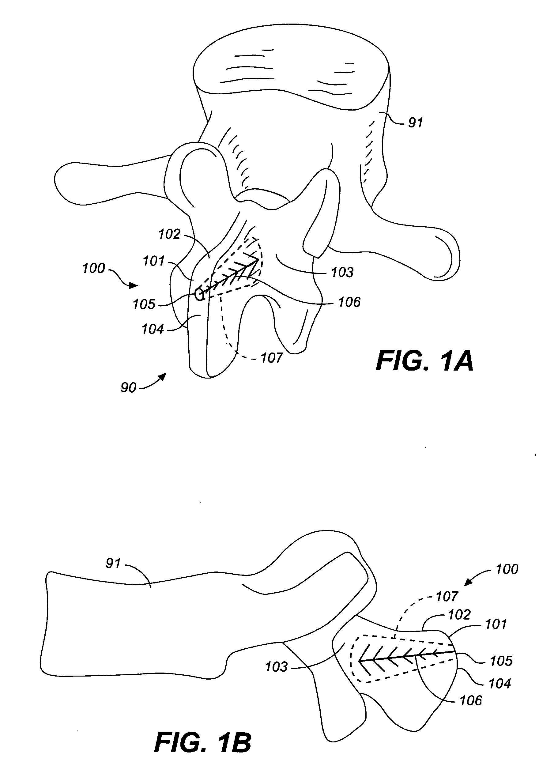 Spine treatment devices and methods