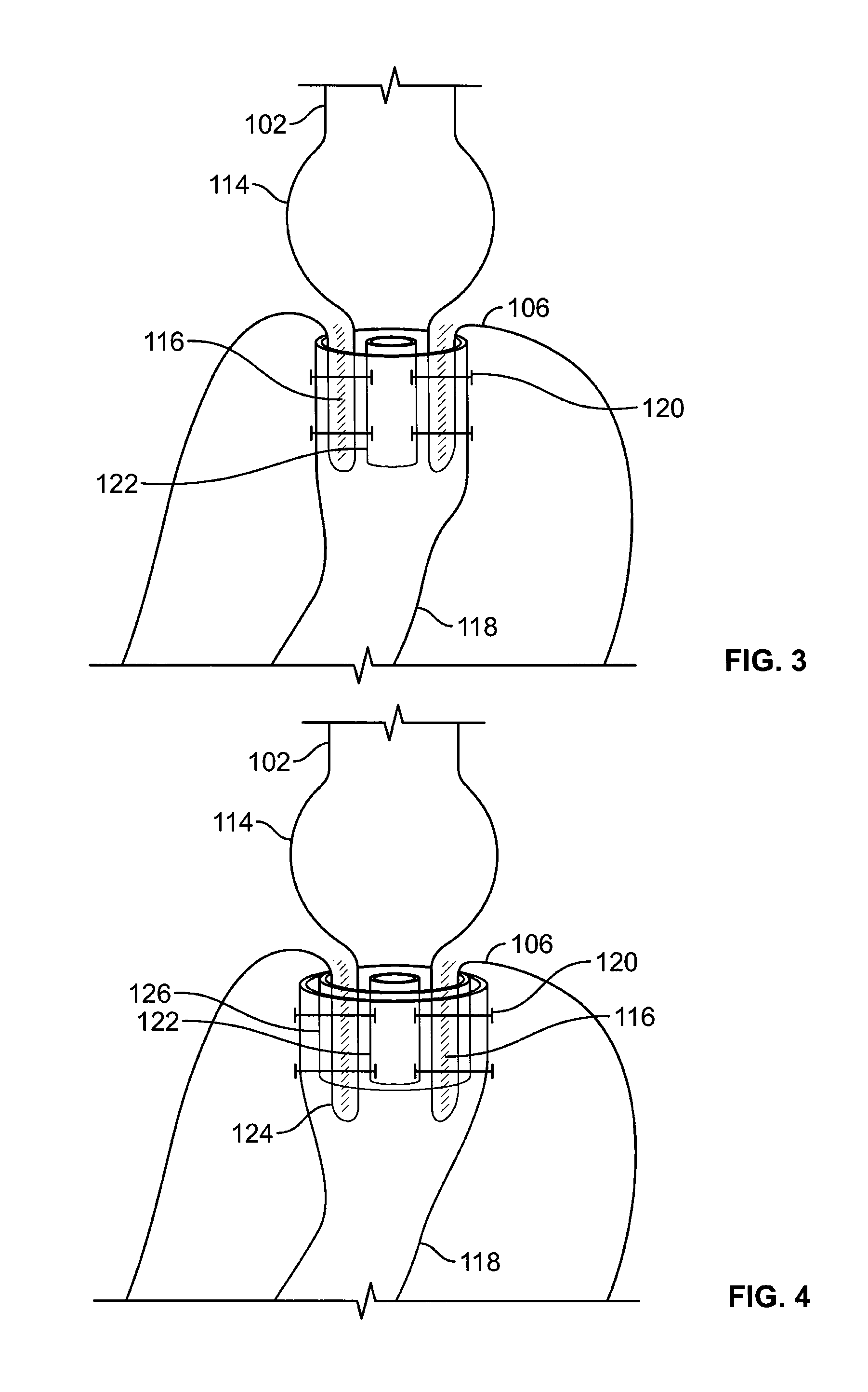 Devices and methods to deliver, retain and remove a separating device in an intussuscepted hollow organ