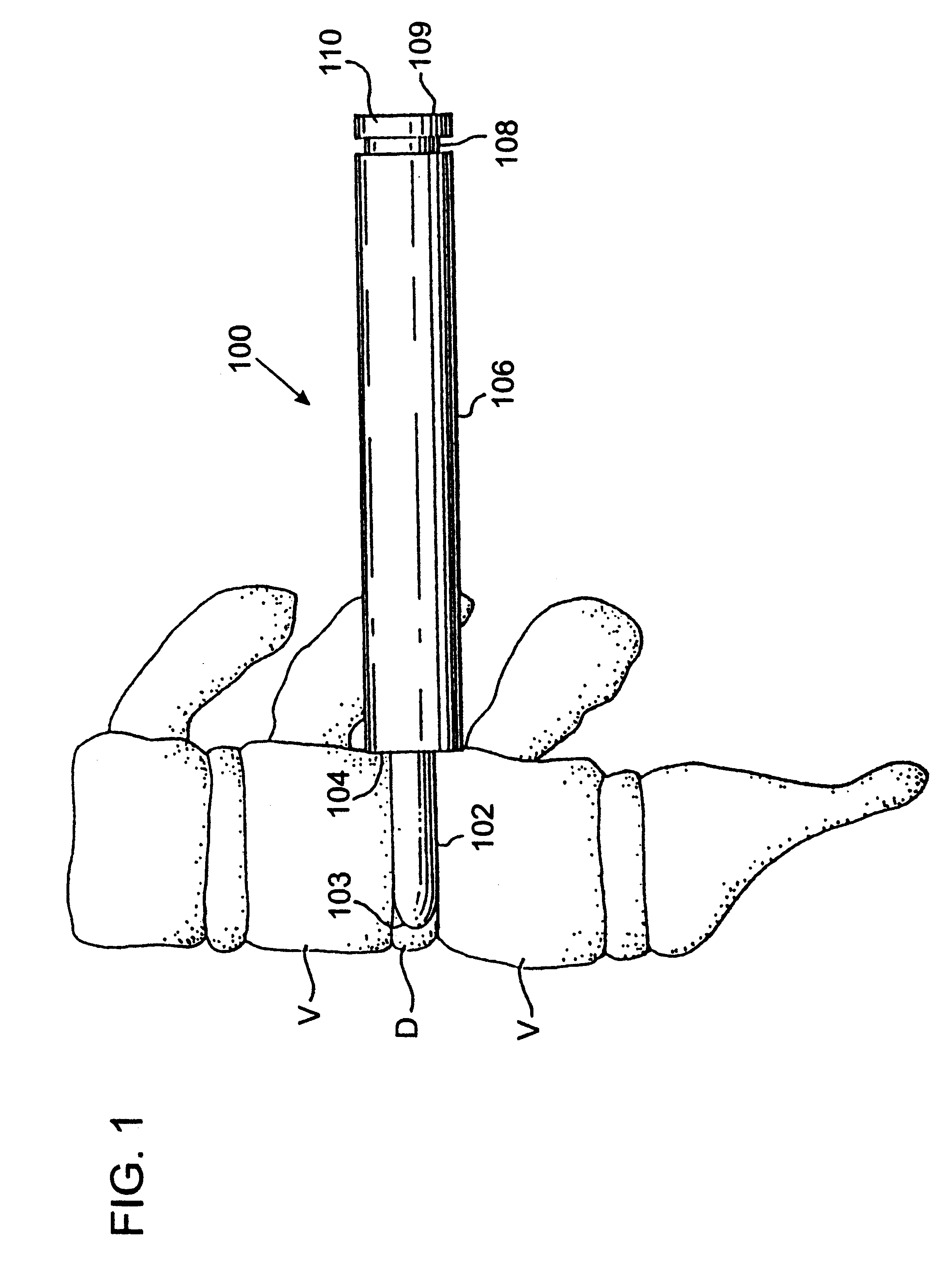 Apparatus for use in inserting spinal implants