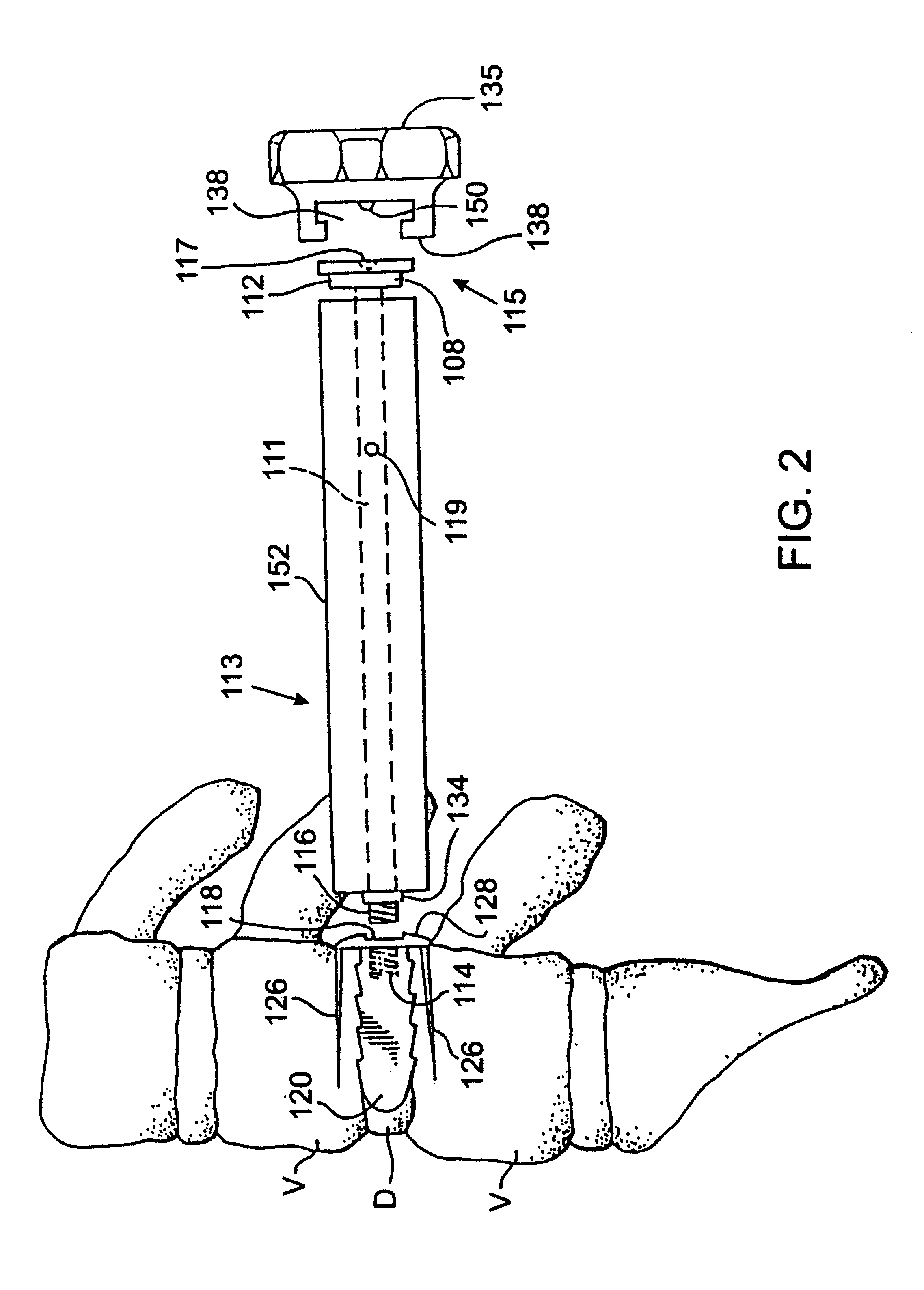 Apparatus for use in inserting spinal implants